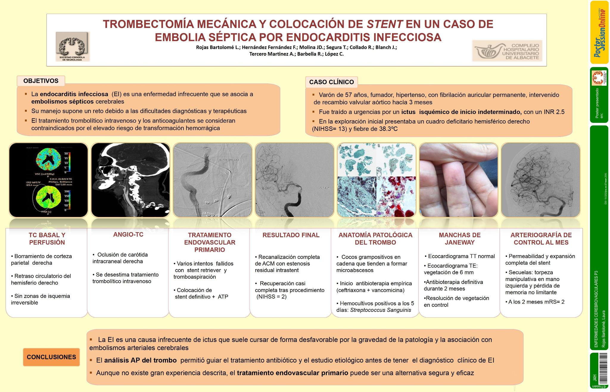 Trombectomía mecánica y colocación de stent en un caso de embolia séptica por endocarditis infecciosa
