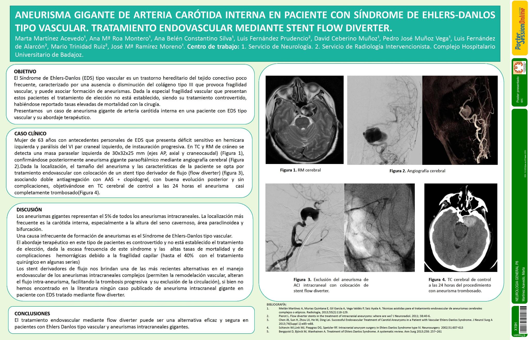 Aneurisma gigante de arteria carótida interna en paciente con síndrome de Ehlers-Danlos tipo vascular. Tratamiento endovascular mediante stent flow diverter