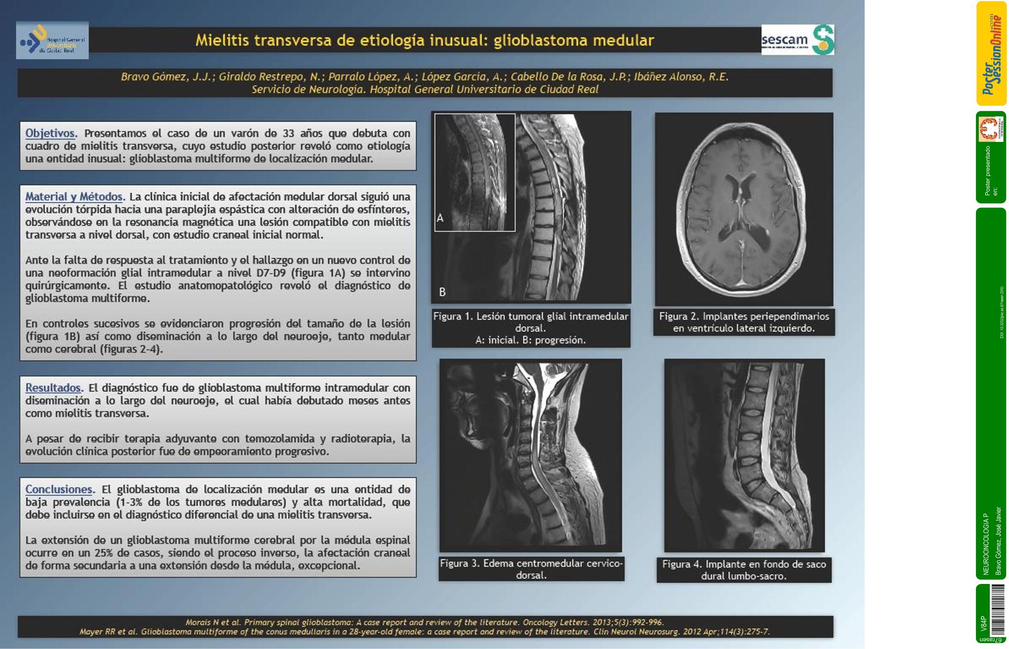 Mielitis transversa de etiología inusual: glioblastoma medular