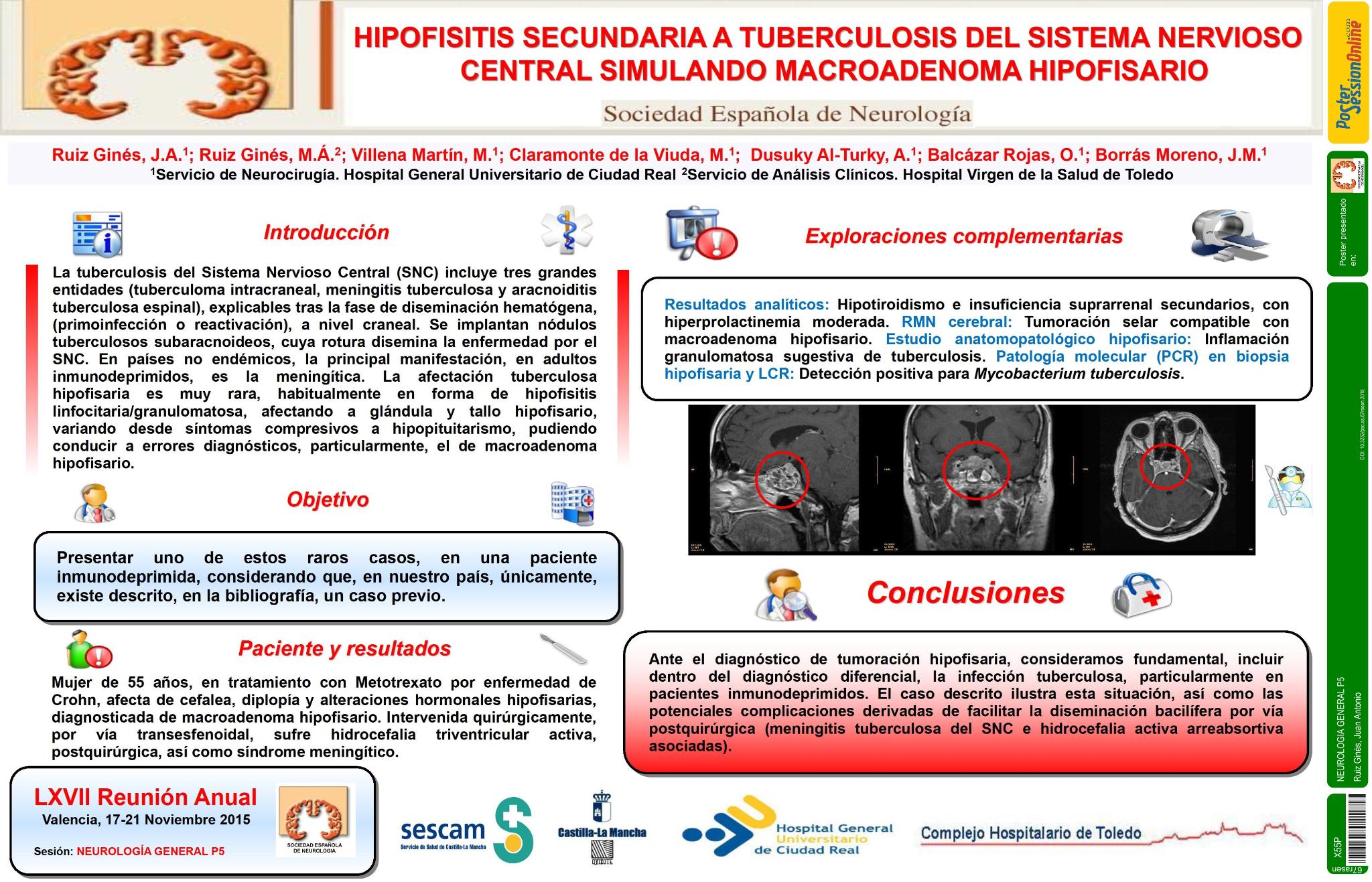 Hipofisitis secundaria a tuberculosis del sistema nervioso central simulando macroadenoma hipofisario