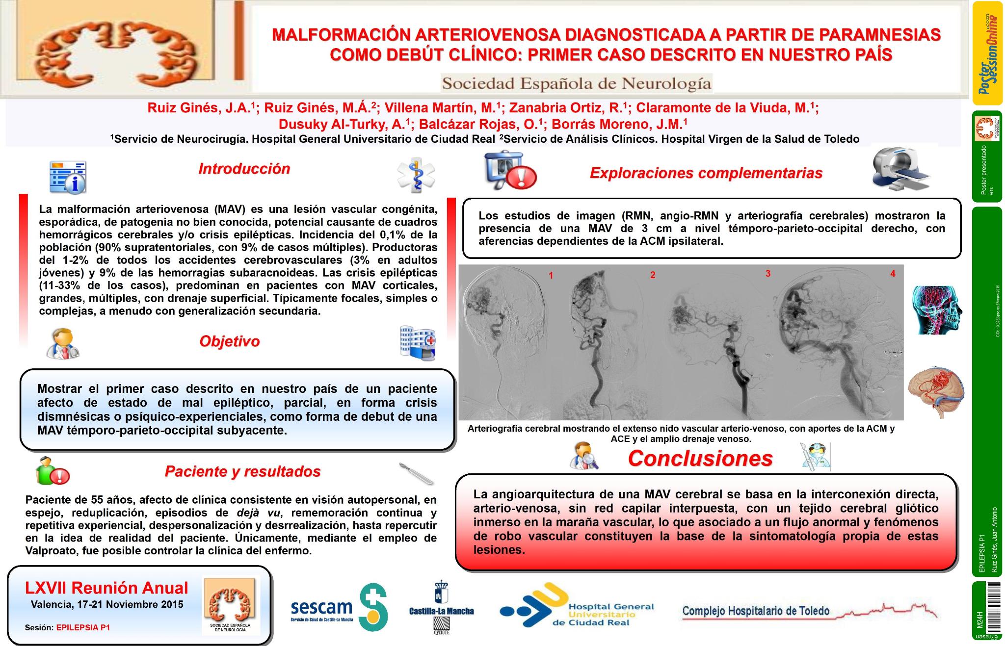 Malformación arteriovenosa diagnosticada a partir de paramnesias como debút clínico: Primer caso descrito en nuestro país