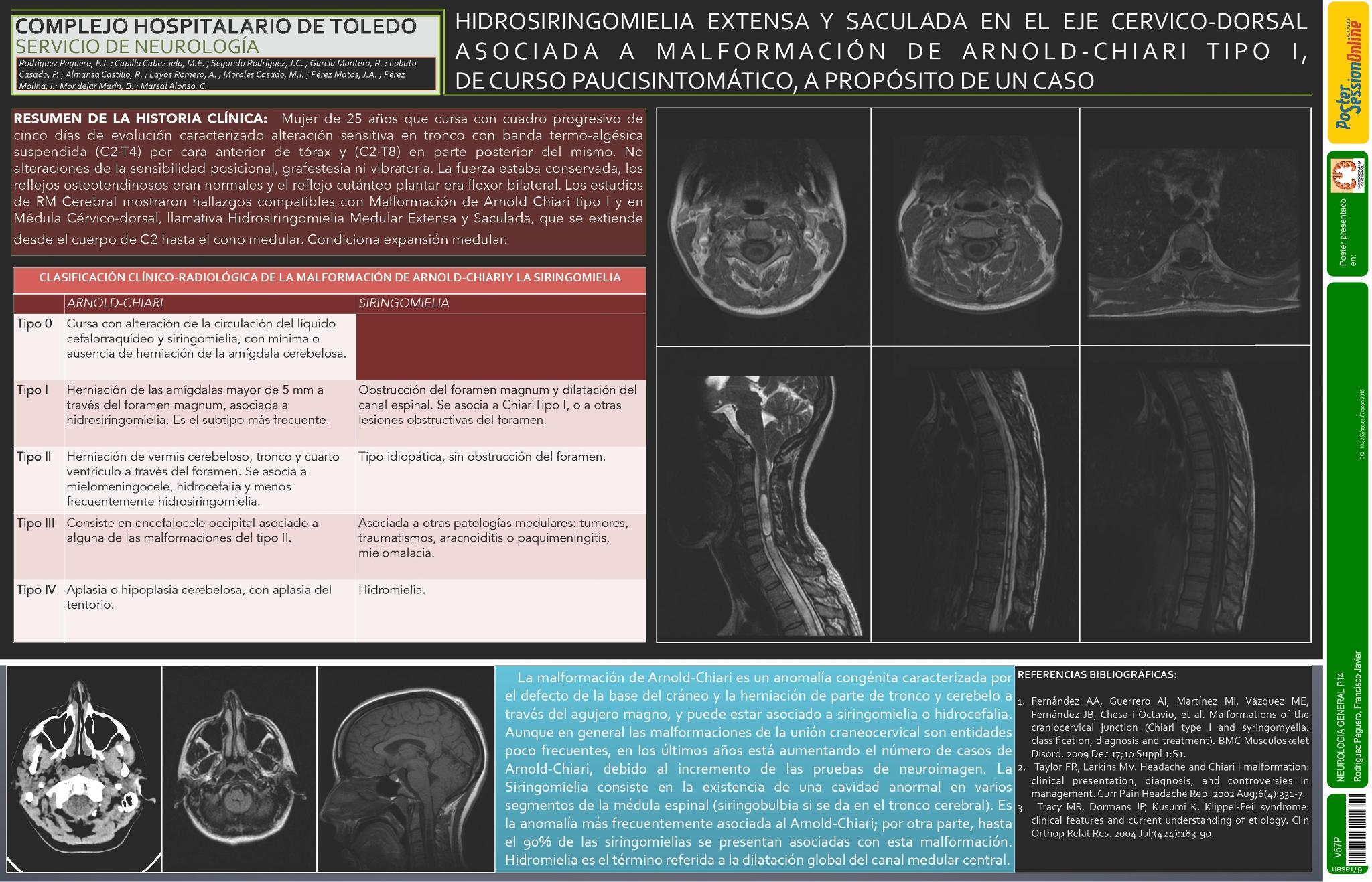 Hidrosiringomielia extensa y saculada en el eje cervico-dorsal asociada a malformacion de Arnold-Chiari tipo I, de curso paucisintomatico, a proposito de un caso