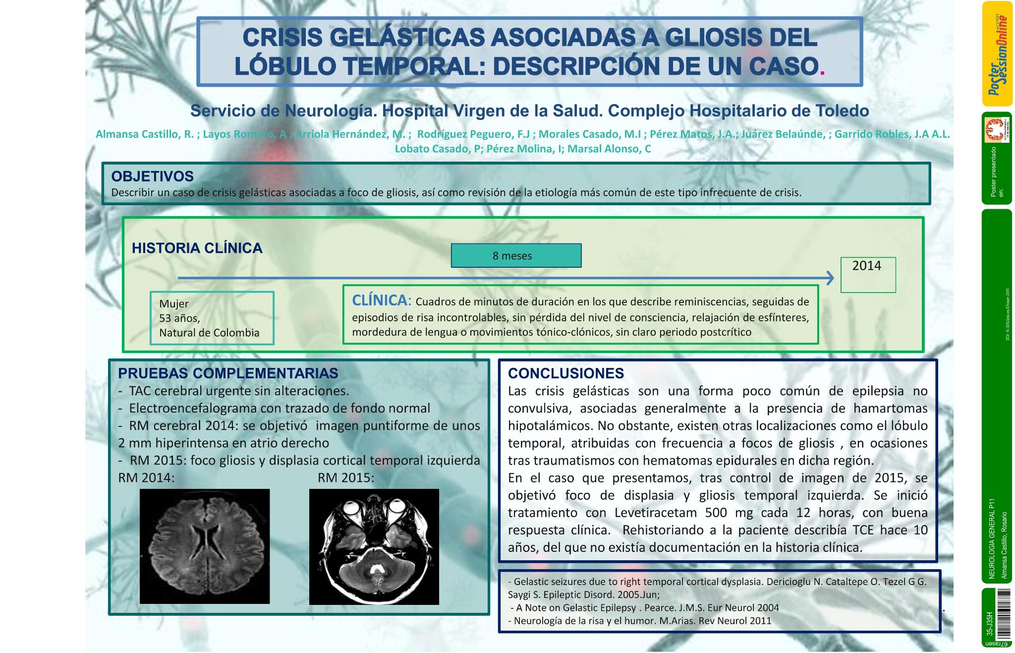 Descripción de un caso de crisis gelásticas asociadas a gliosis del lóbulo temporal