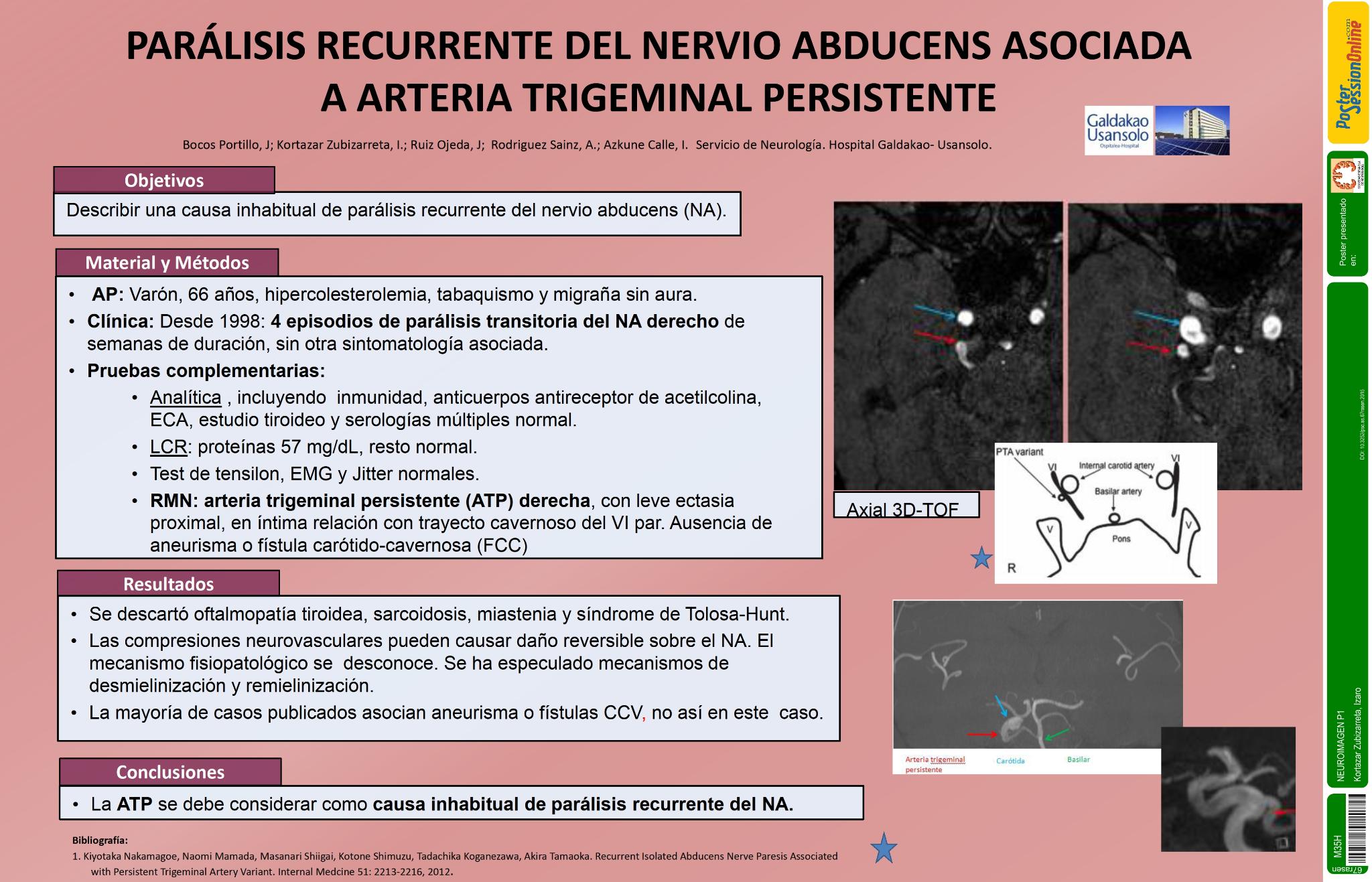 Parálisis recurrente del nervio abducens asociada a arteria trigeminal persistente
