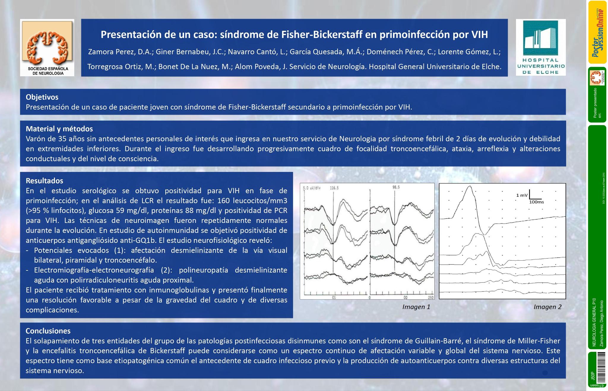 Presentación de un caso: síndrome de Fisher-Bickerstaff en primoinfección por VIH