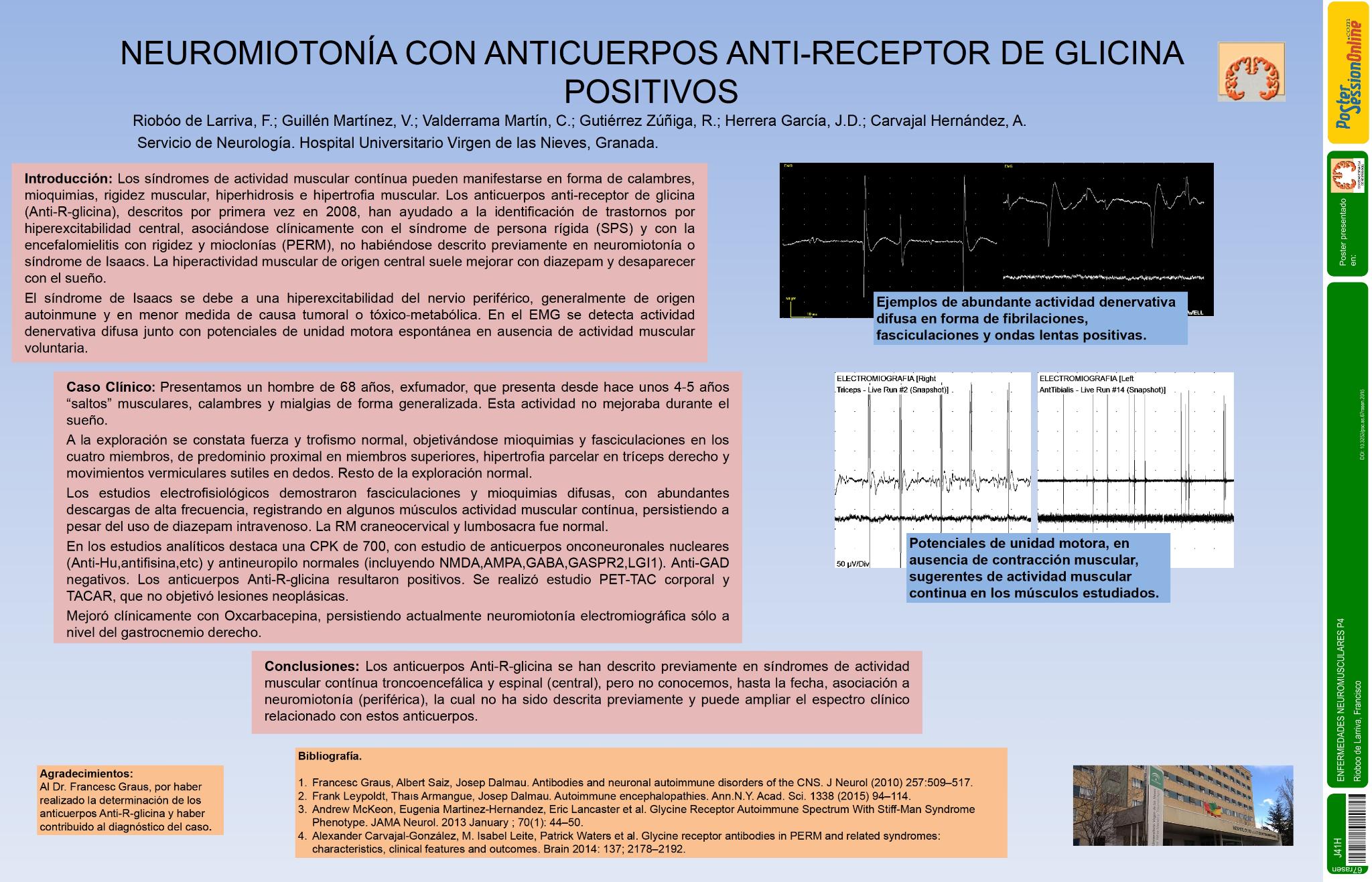 Neuromiotonía con anticuerpos anti-receptor de glicina positivos