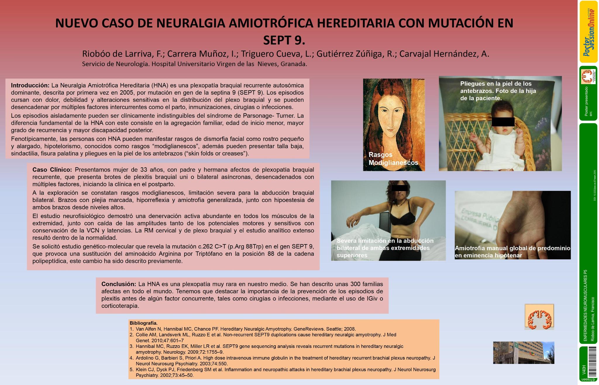Nuevo caso de Neuralgia Amiotrófica Hereditaria con mutación en SEPT 9