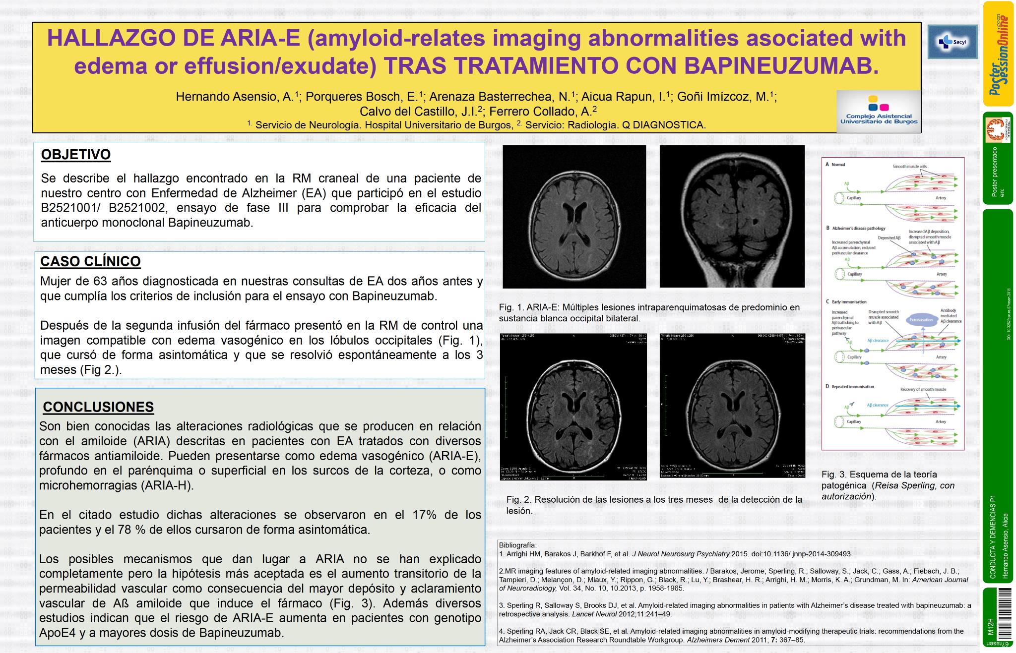 Hallazgo de ARIA-E (amyloid-relates imaging abnormalities asociated with edema or effusion/exudate) tras tratamiento con Bapineuzumab