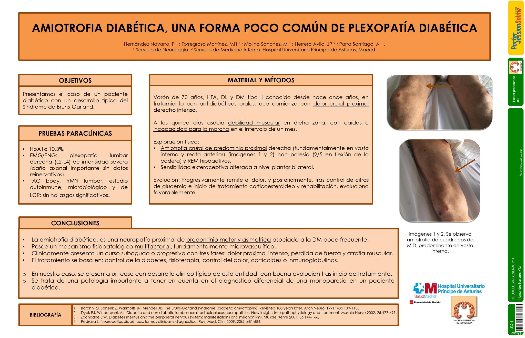 Amiotrofia diabética, una forma poco común de neuropatía diabética