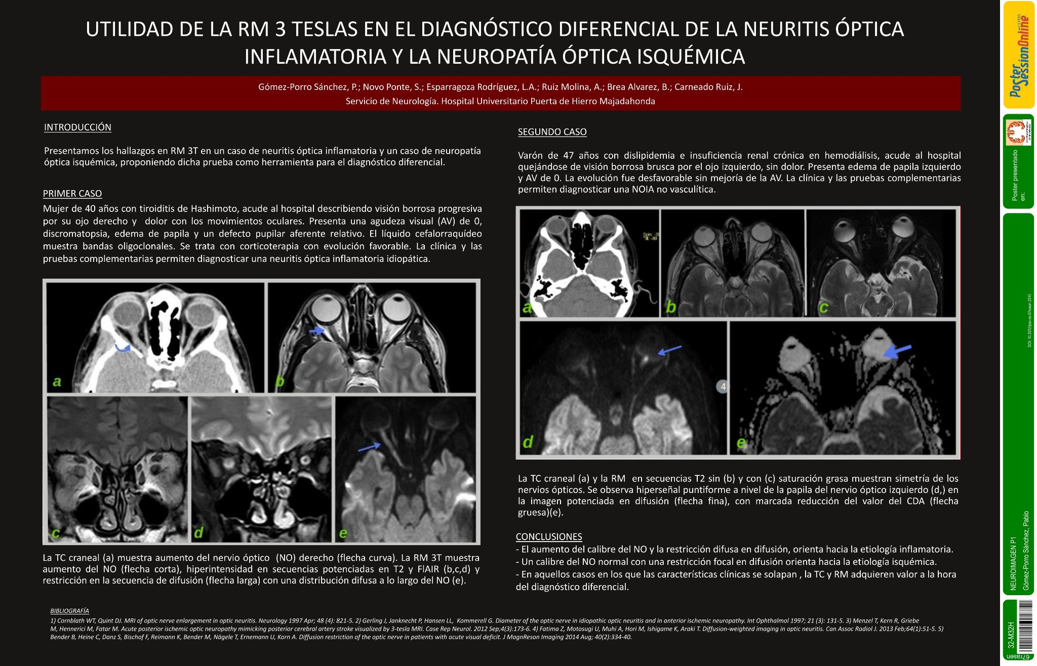 Utilidad de la RM 3 TESLAS en el diagnóstico diferencial de la neuritis óptica inflamatoria y la neuropatía óptica isquémica