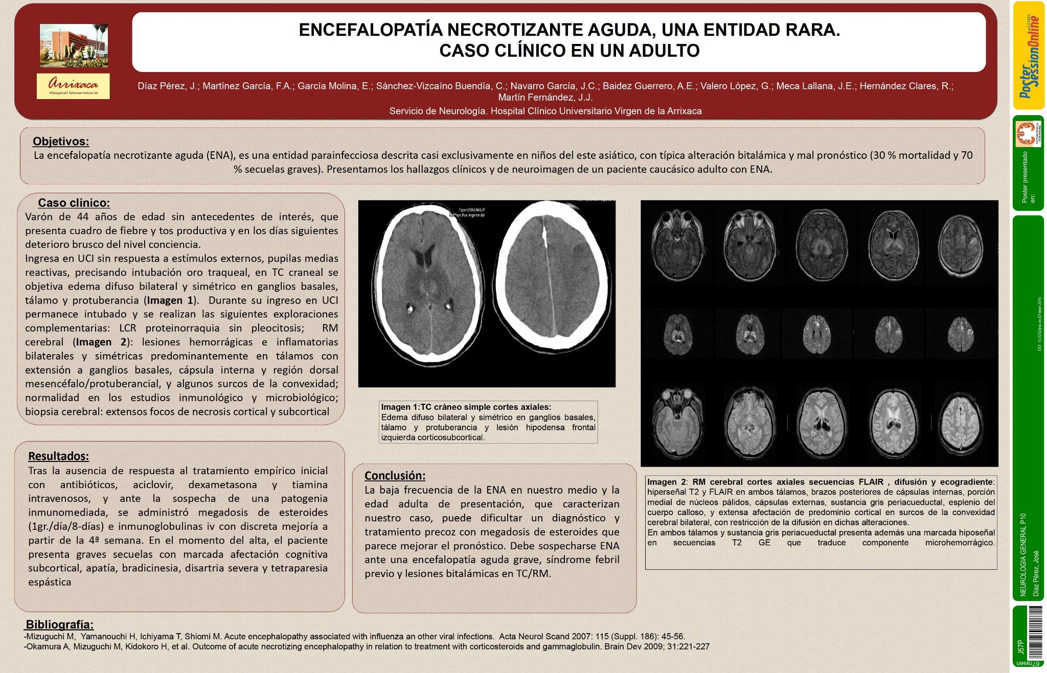 Encefalopatía necrotizante aguda, una entidad rara. Caso clínico en un adulto