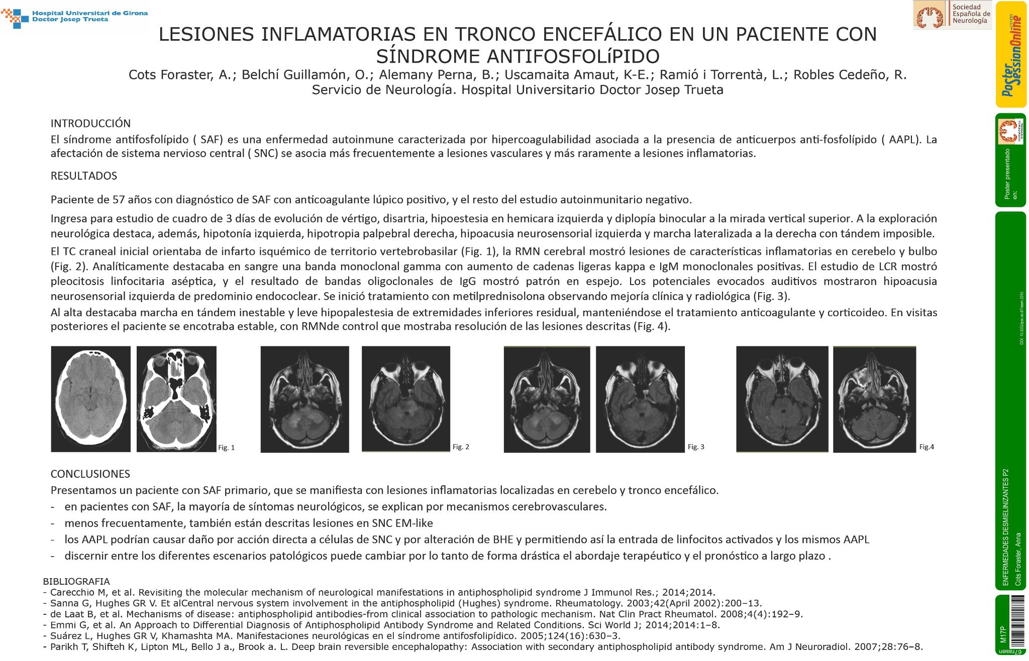 Lesiones inflamatorias en tronco encefálico en paciente con síndrome antifosfolípido