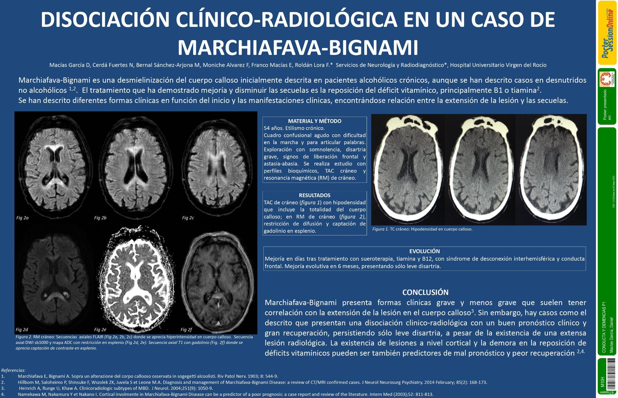 Disociación clinico-radiológica en un caso de Marchiafava-Bignami