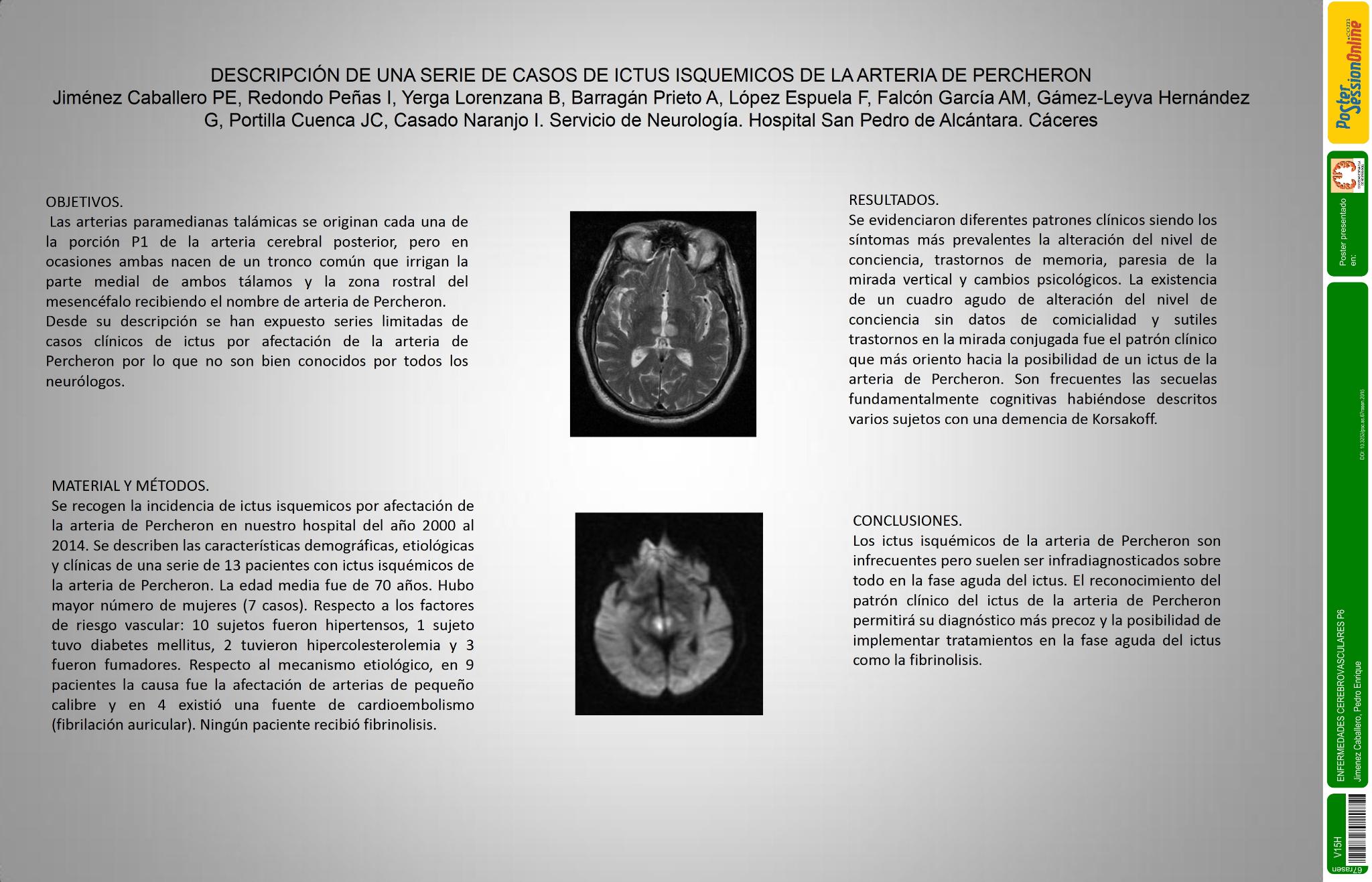 Descripción de una serie de casos de ictus isquemicos de la arteria de Percheron