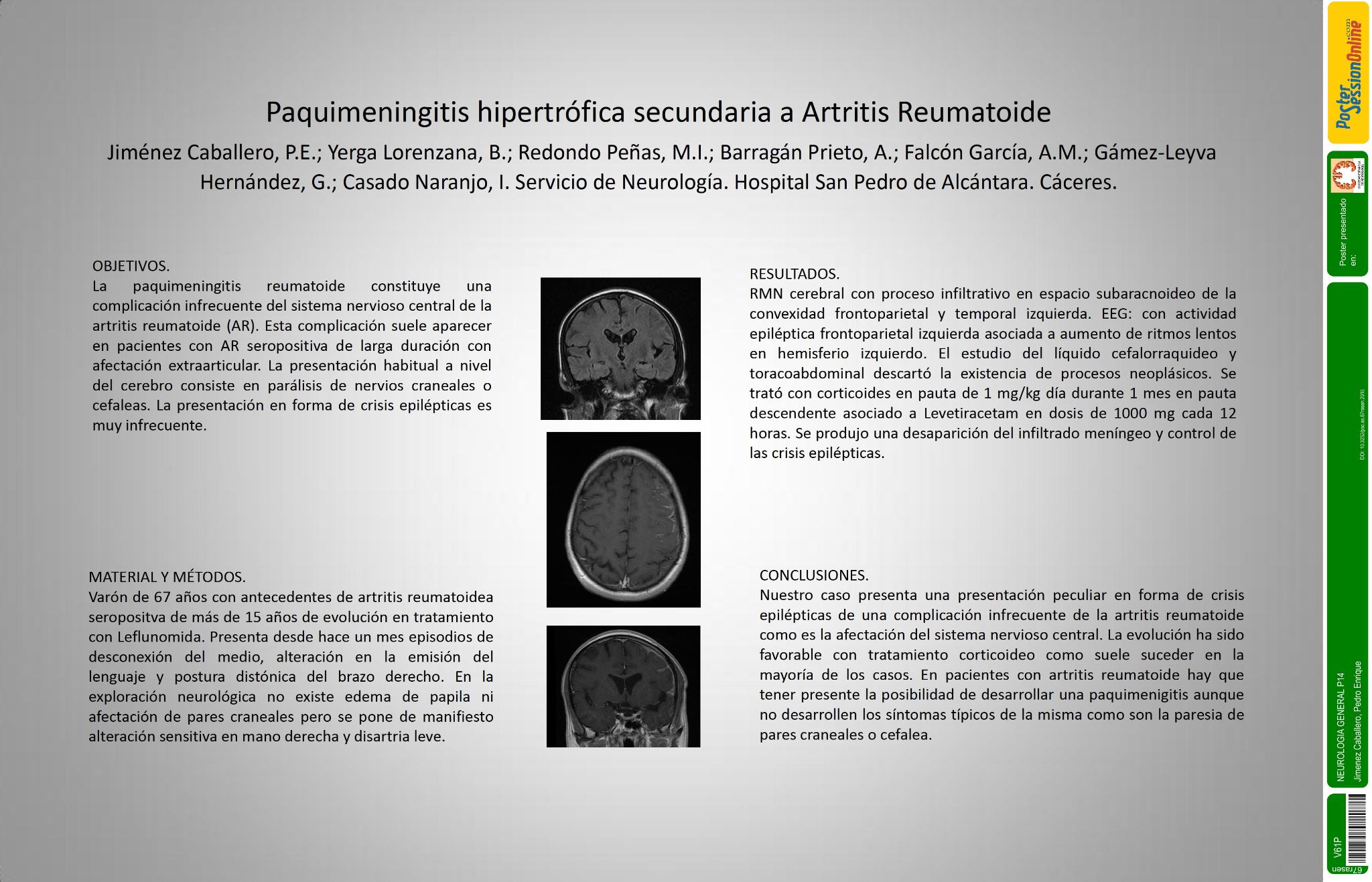Epilepsia secundaria a paquimeningitis reumatoide