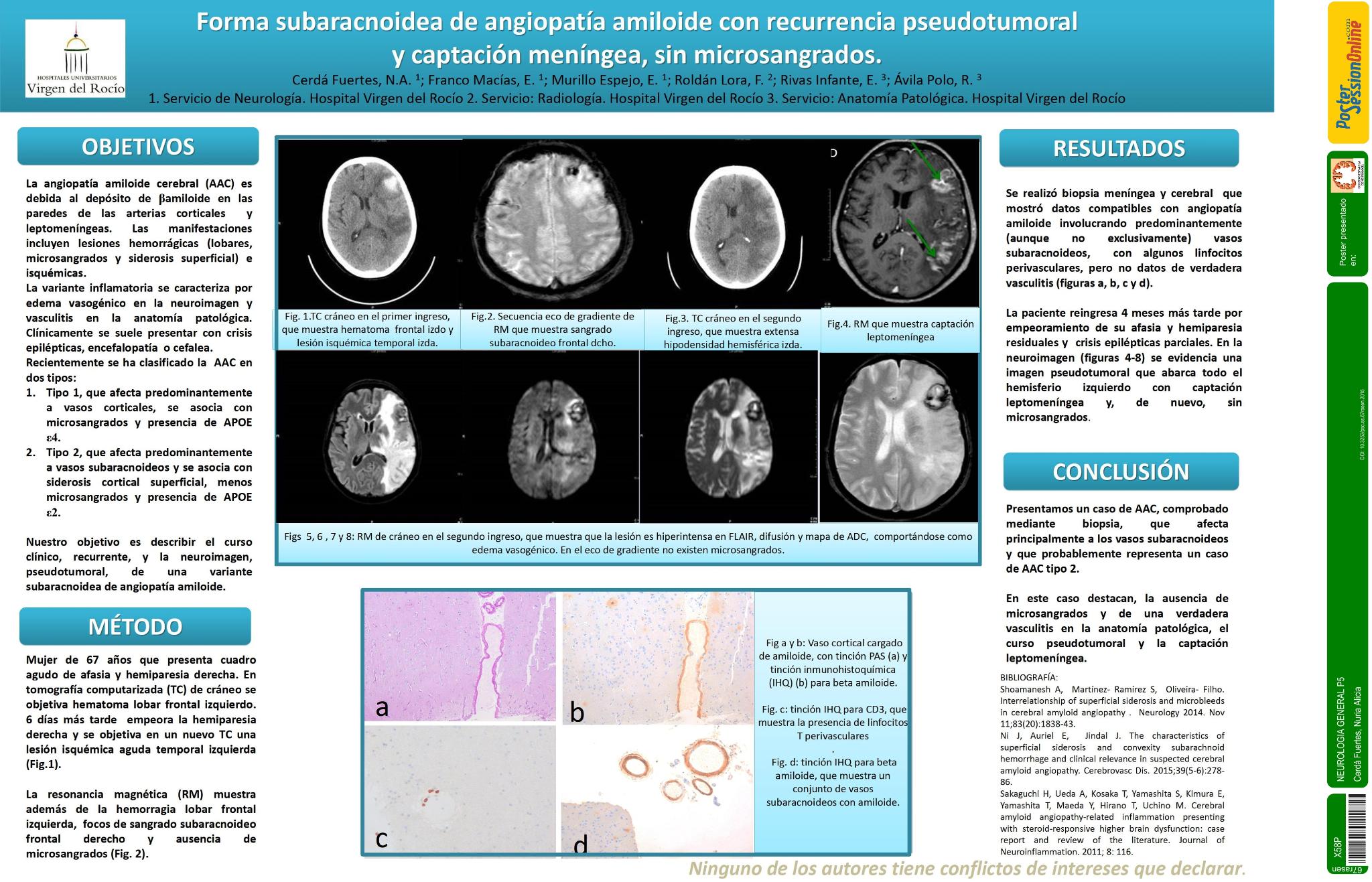Forma subaracnoidea de angiopatía amiloide con recurrencia pseudotumoral y captación meníngea, sin microsangrados