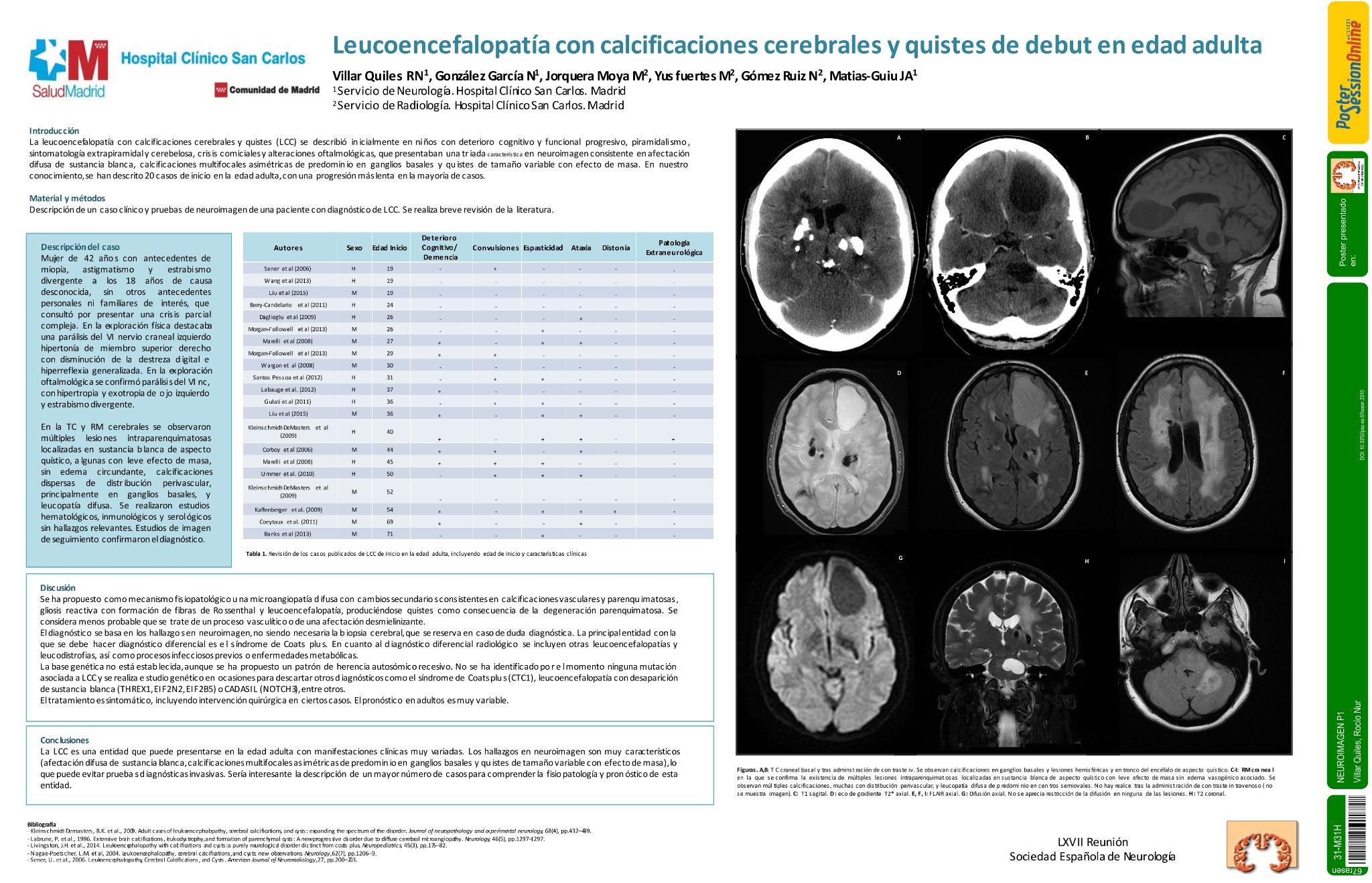 Leucoencefalopatía con calcificaciones cerebrales y quistes de debut en edad adulta