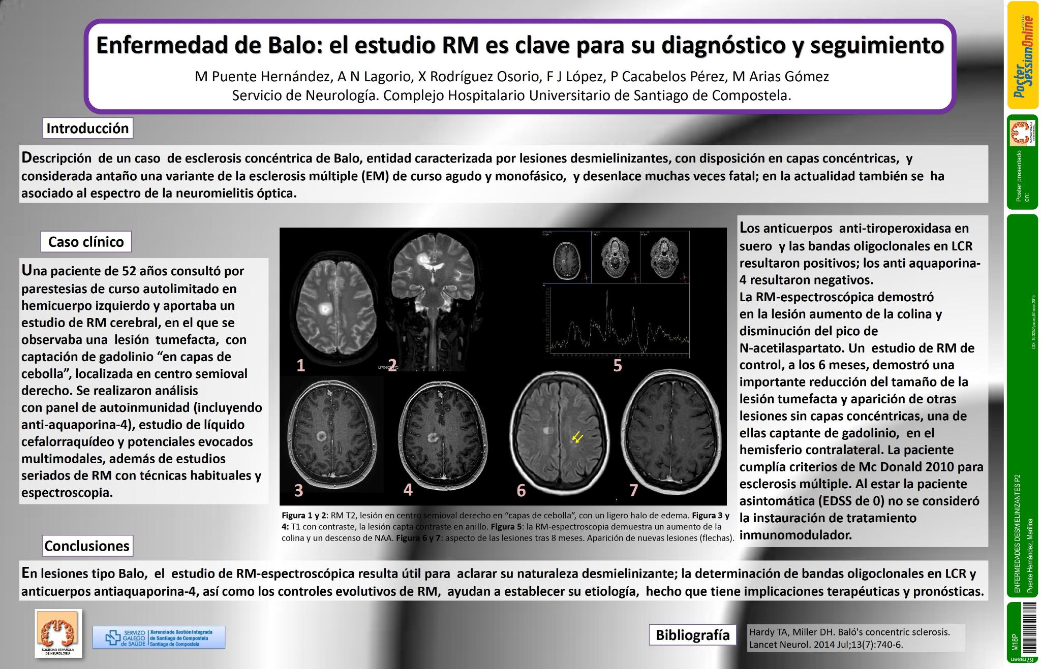 Enfermedad de Baló: el estudio  de  RM es clave para su  diagnóstico y seguimiento