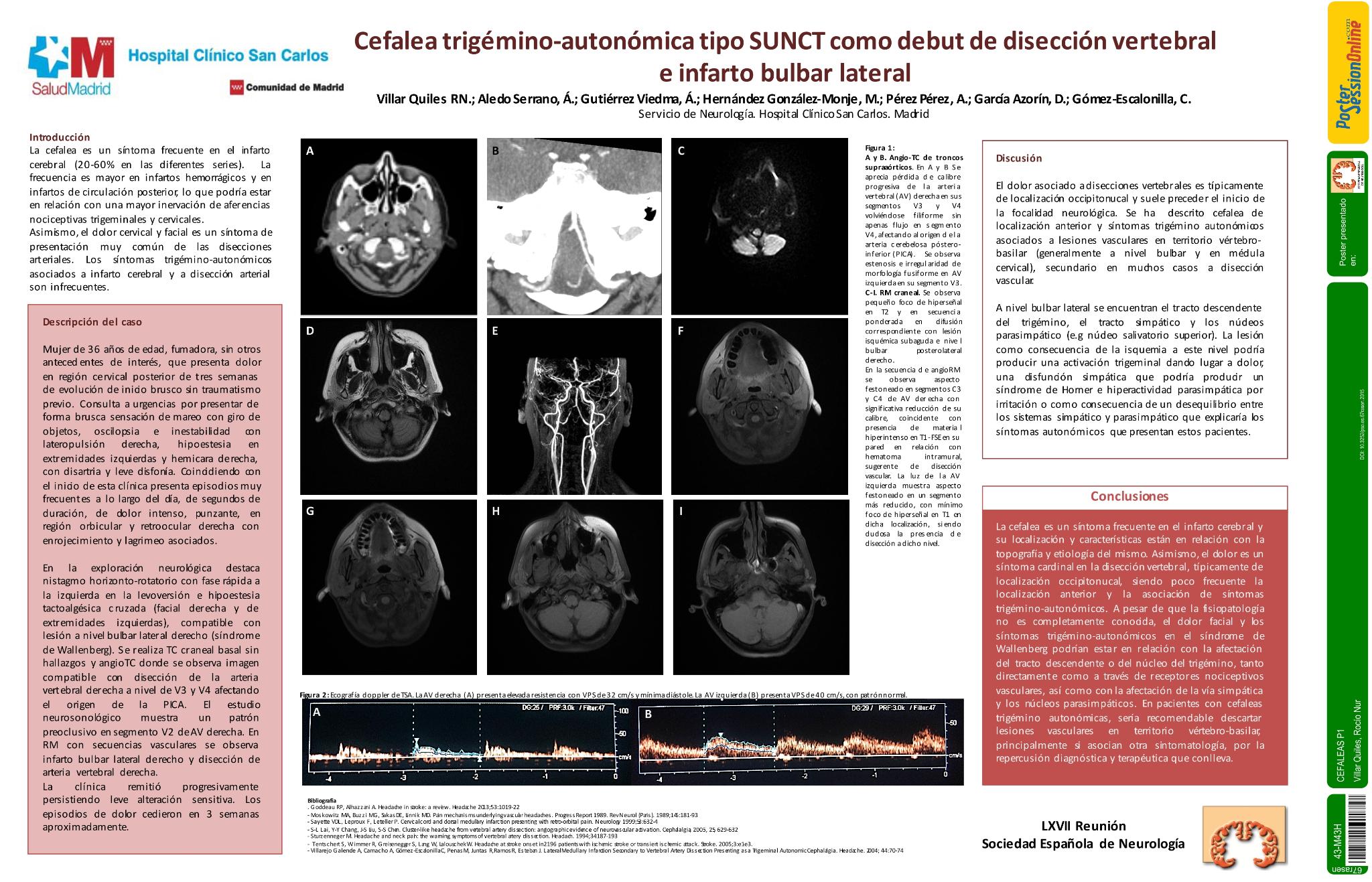 Cefalea trigémino-autonómica tipo SUNCT como debut de disección vertebral e infarto bulbar lateral