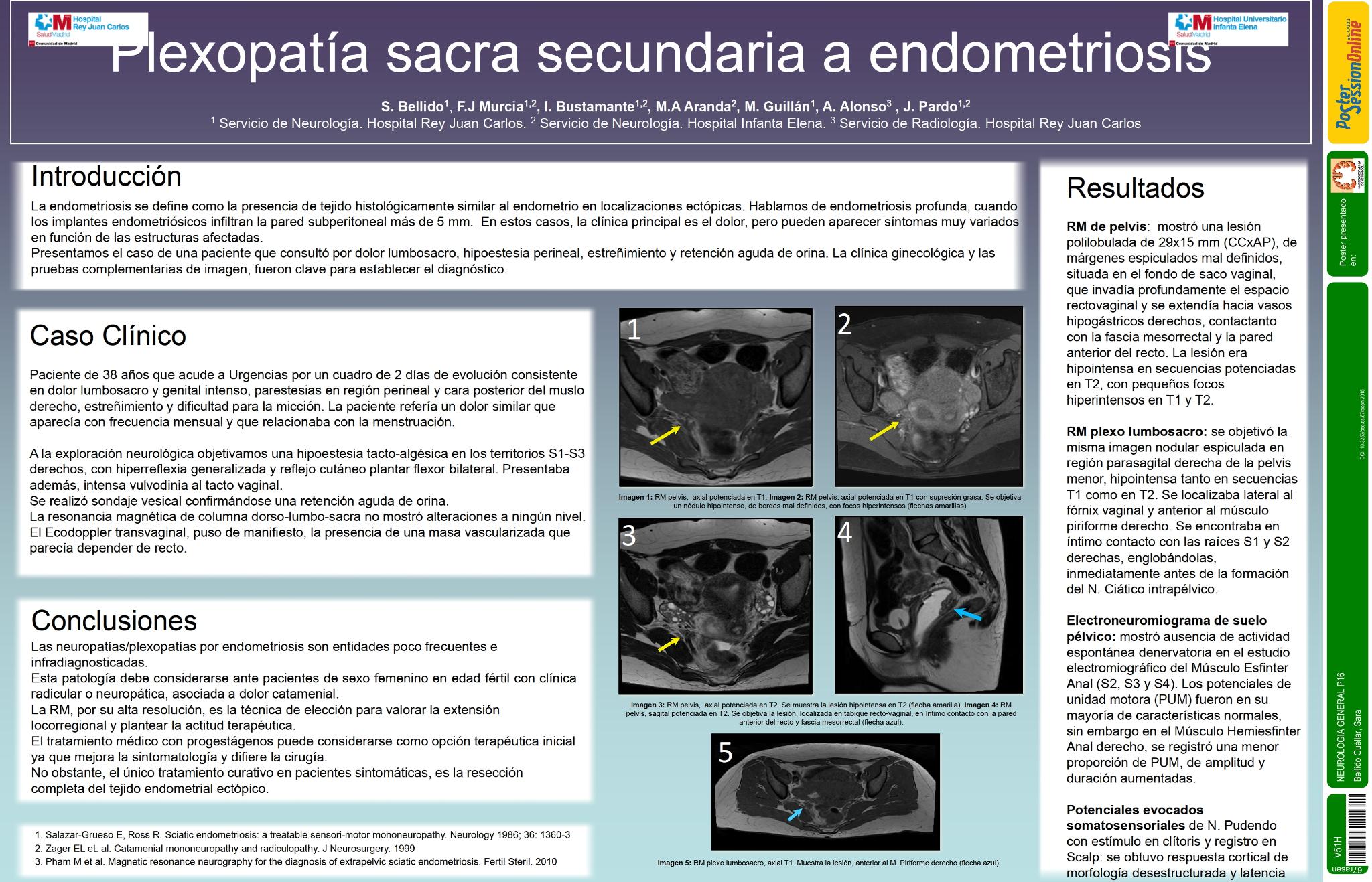 Plexopatía sacra secundaria a endometriosis