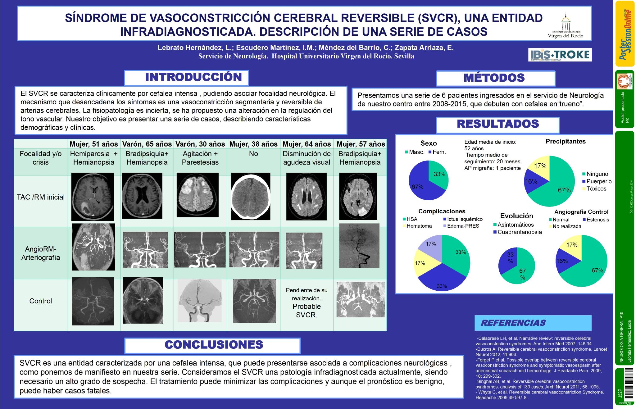 Síndrome de vasoconstricción cerebral reversible (SVCR), una entidad infradiagnosticada. A propósito de 6 casos