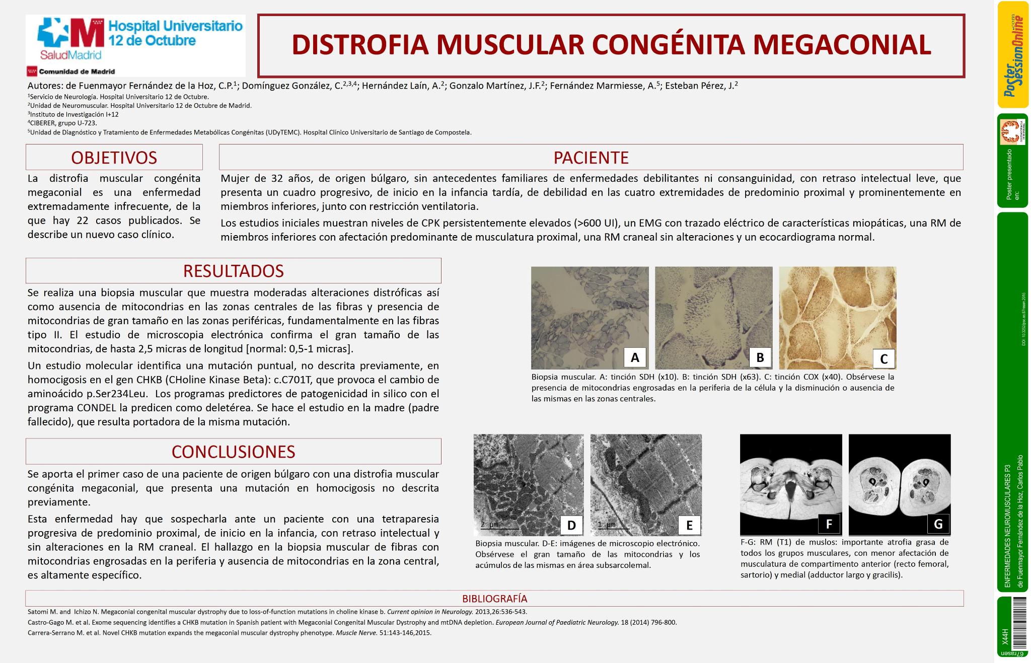 Distrofia muscular congénita megaconial por una nueva mutación del gen CHKB