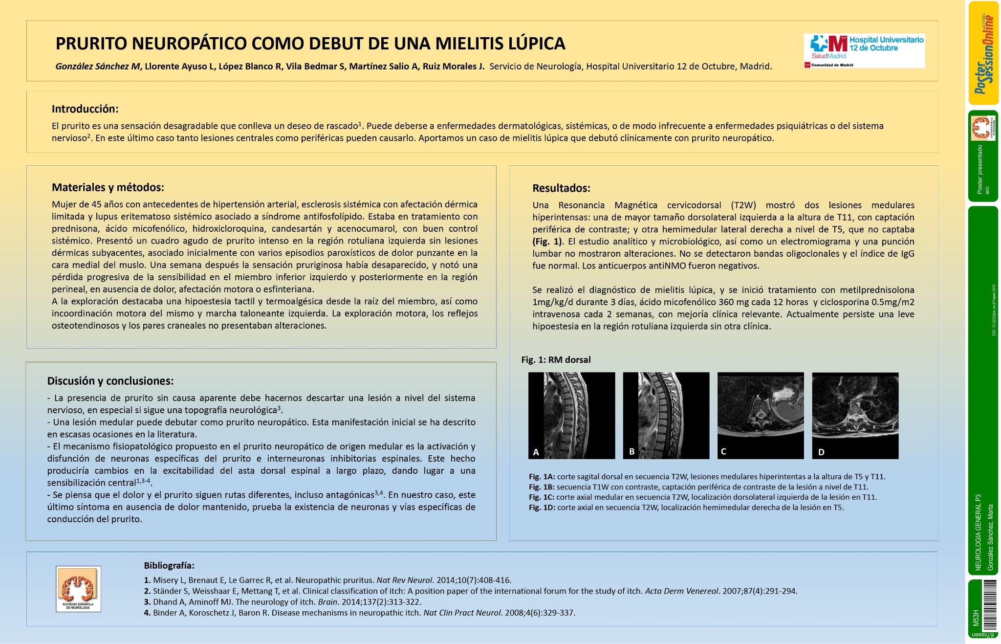 Prurito neuropático como debut de una mielitis lúpica