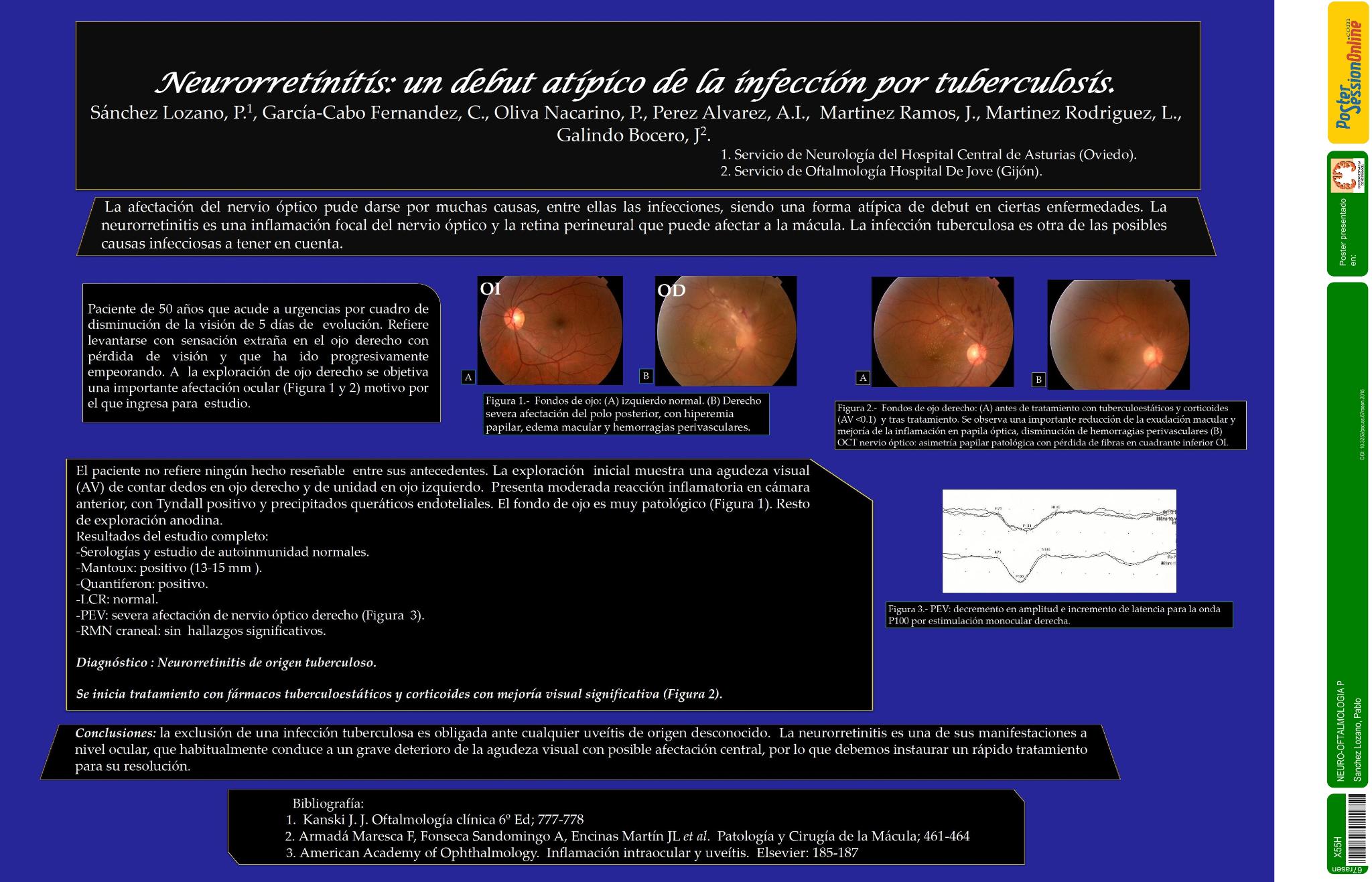 Neurorretinitis: un debut atípico de la infección por tuberculosis