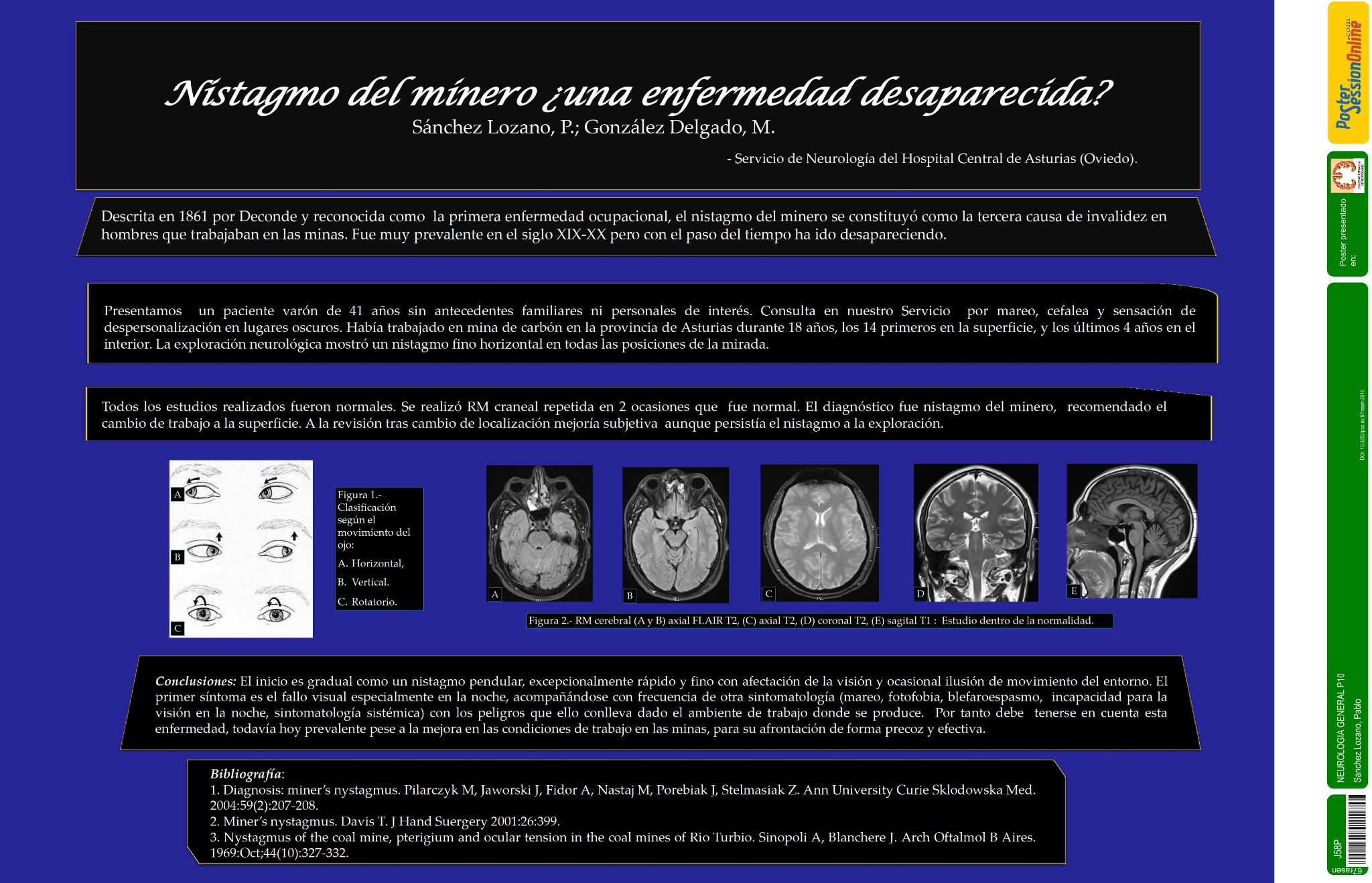 El nistagmo del minero ¿una enfermedad desaparecida?