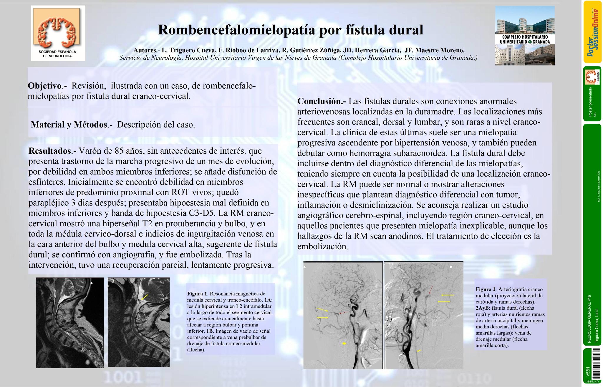 Rombencefalomielopatía por fístula dural