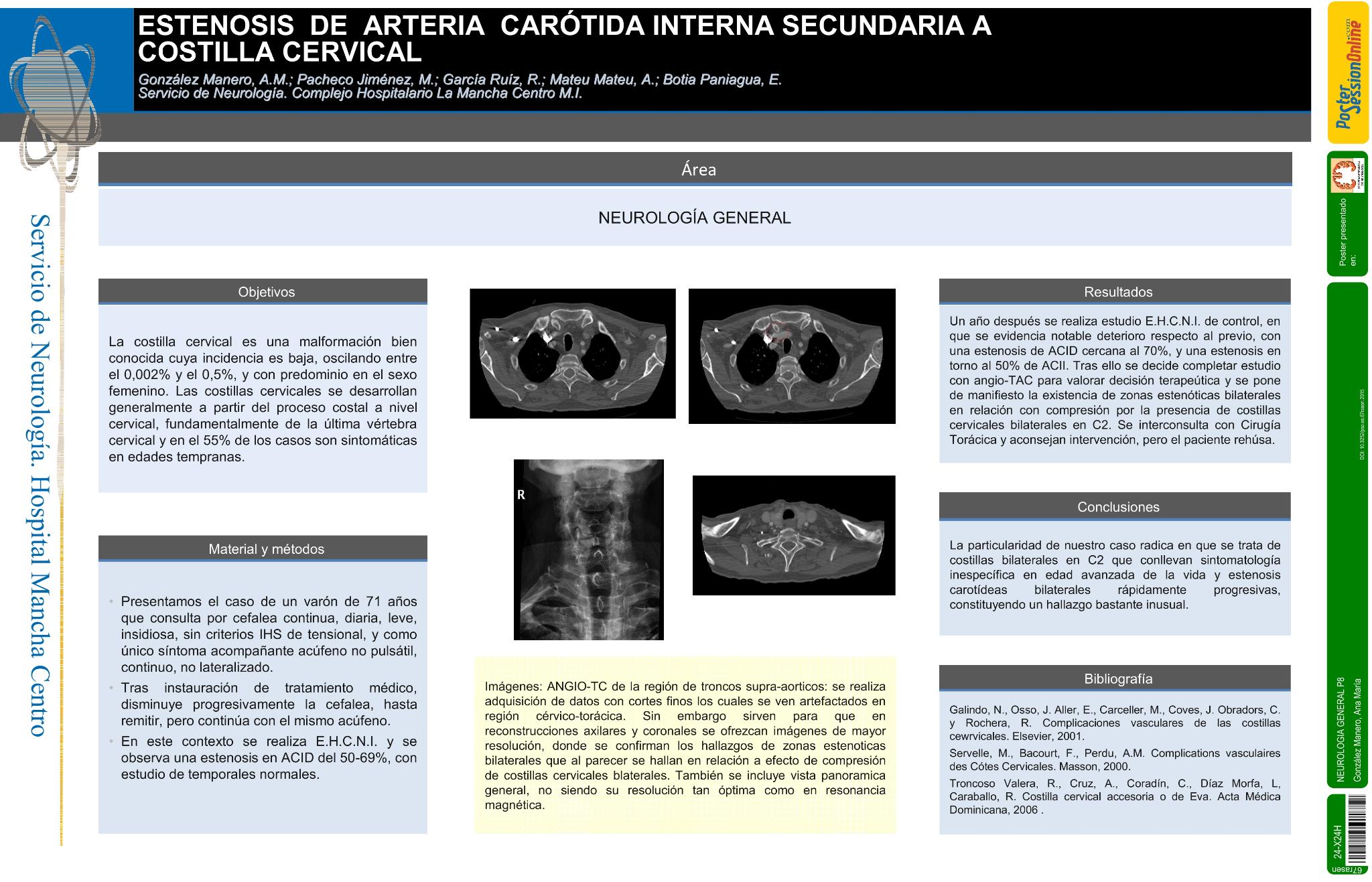 Estenosis de arteria carótida interna secundaria a costilla cervical a nivel de C2