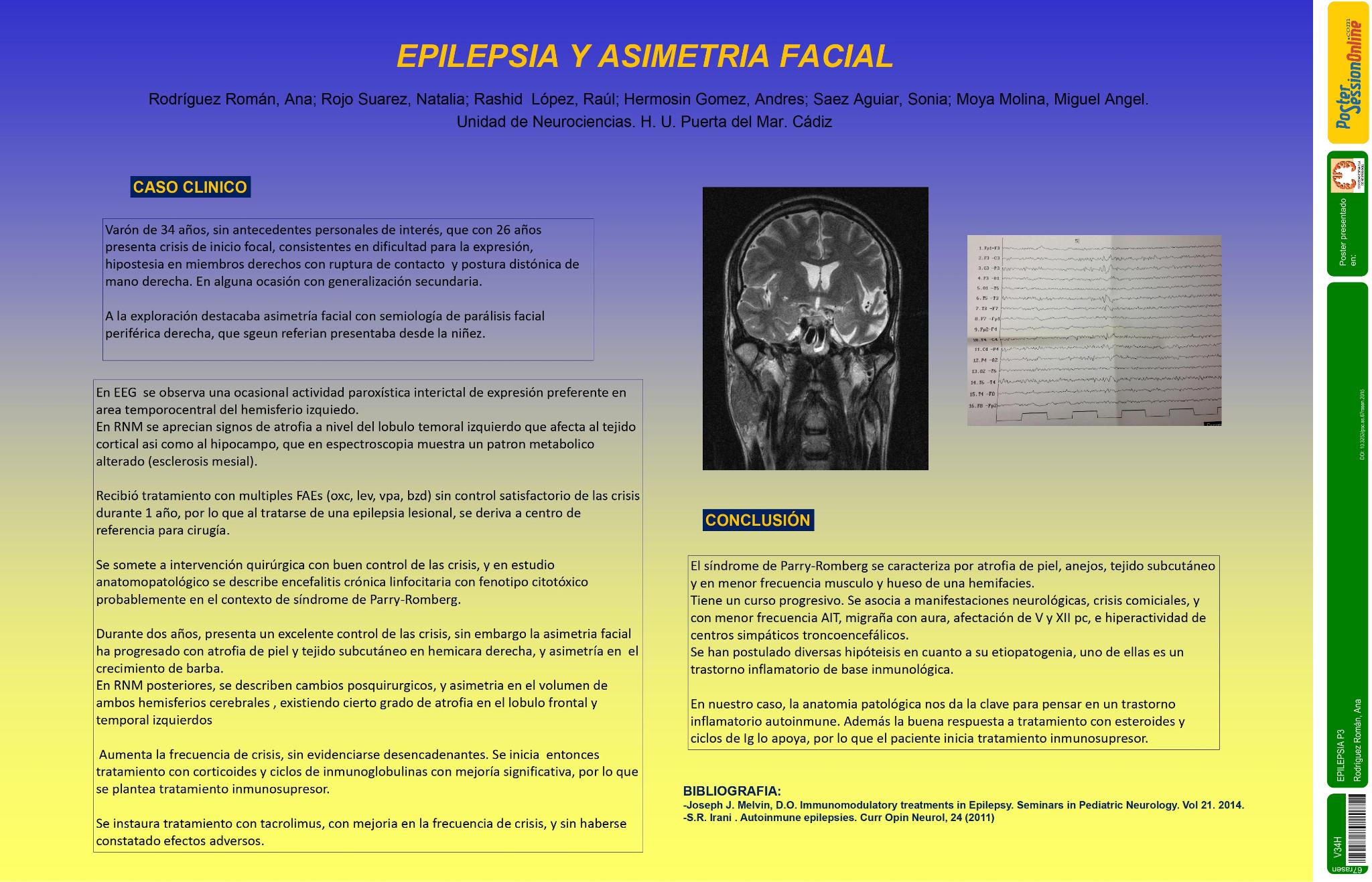 Epilepsia y asimetria facial