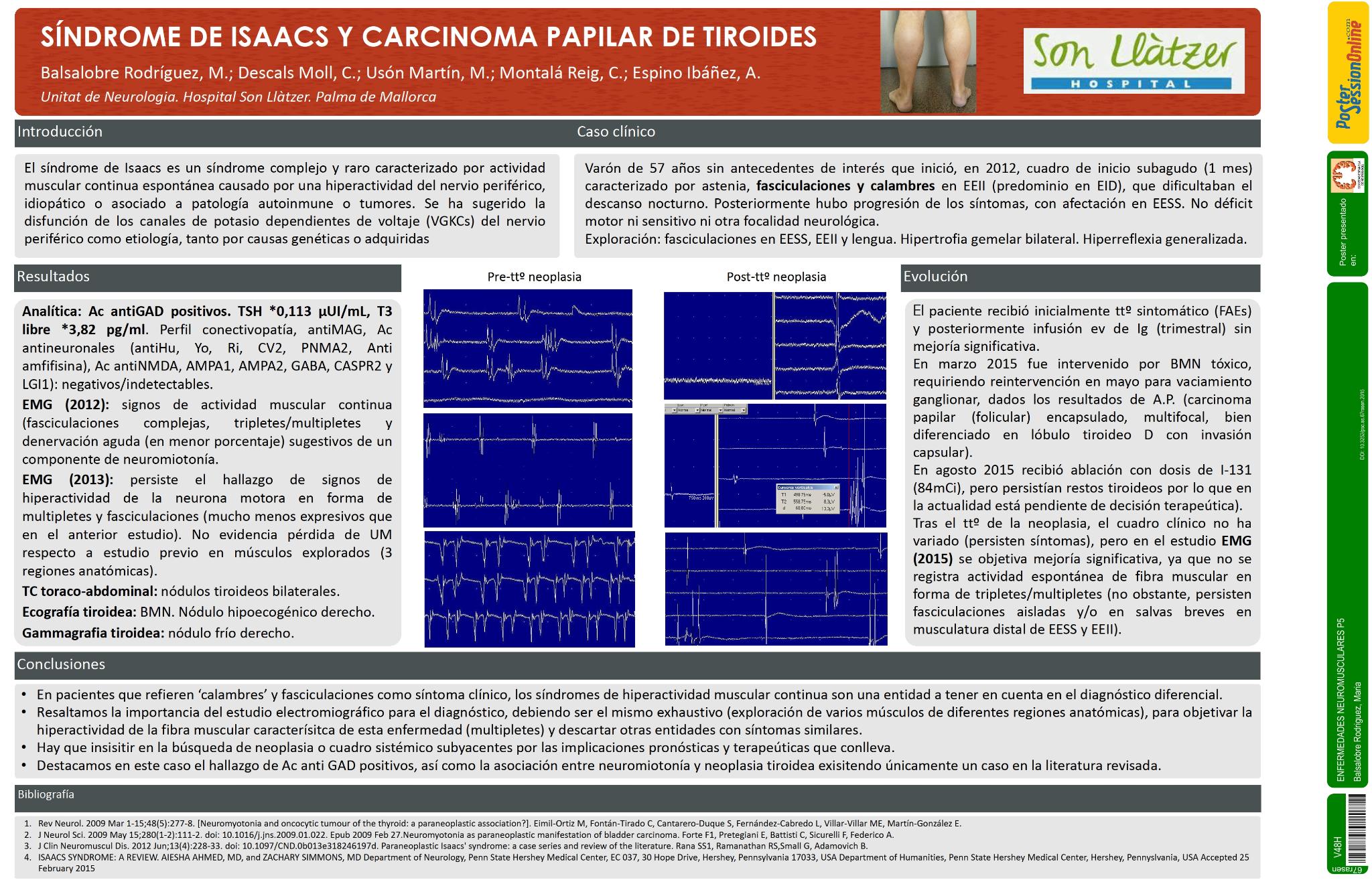 Sindrome de Isaacs y carcinoma papilar de tiroides
