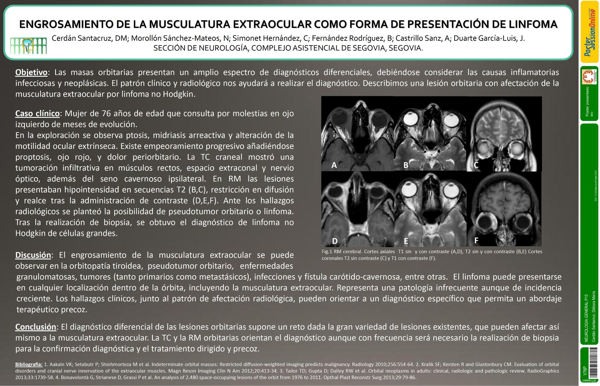 Engrosamiento de la musculatura extraocular como forma de presentación de linfoma