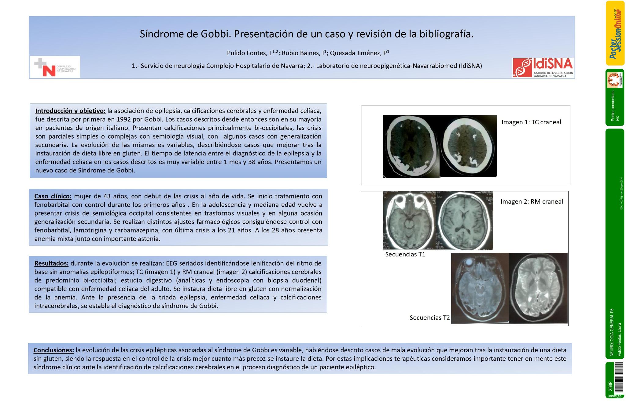 Síndrome de Gobbi. Presentación de un caso y revisión de la bibliografía