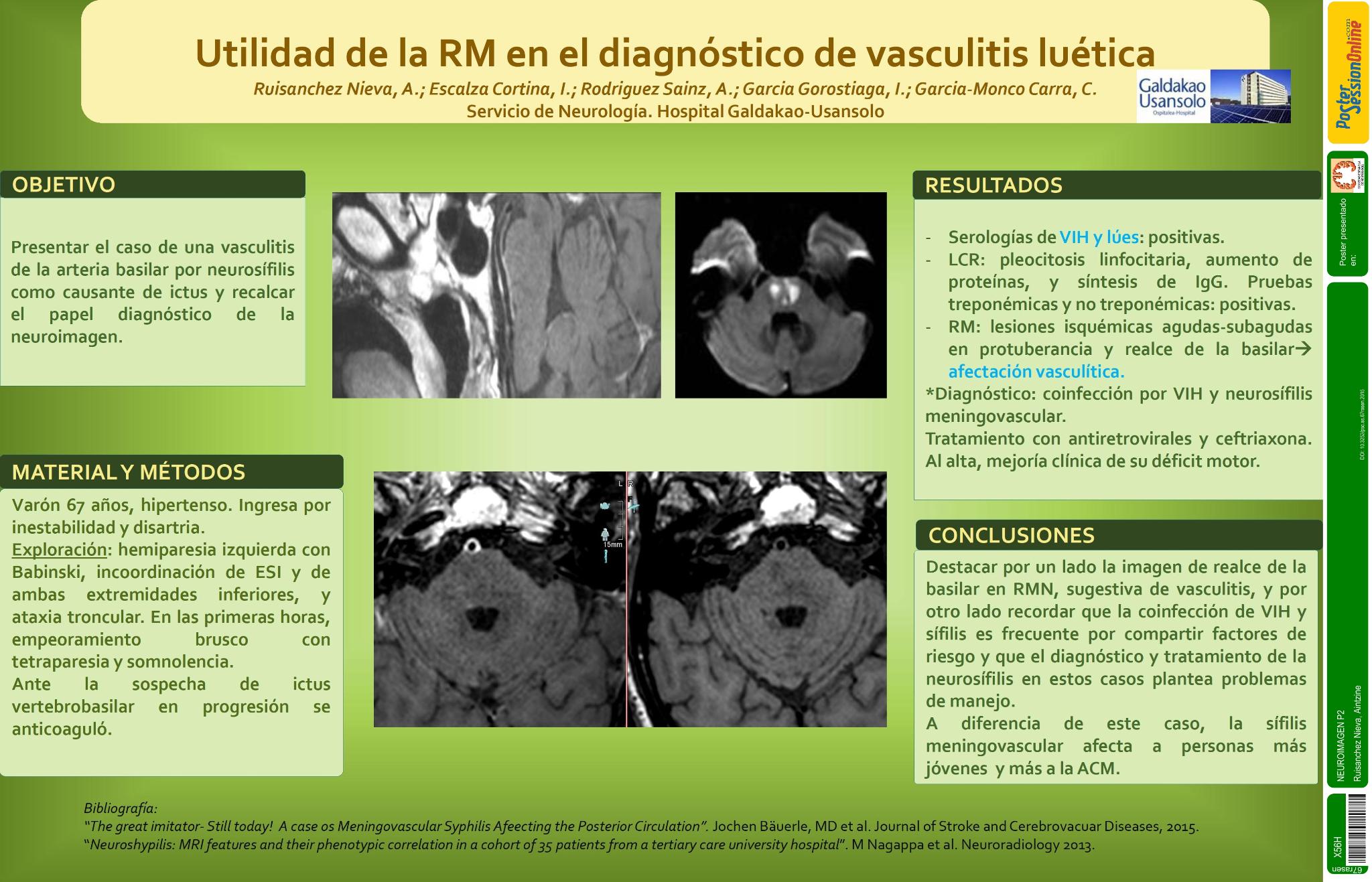 Utilidad de la RM en el diagnóstico de vasculitis luética