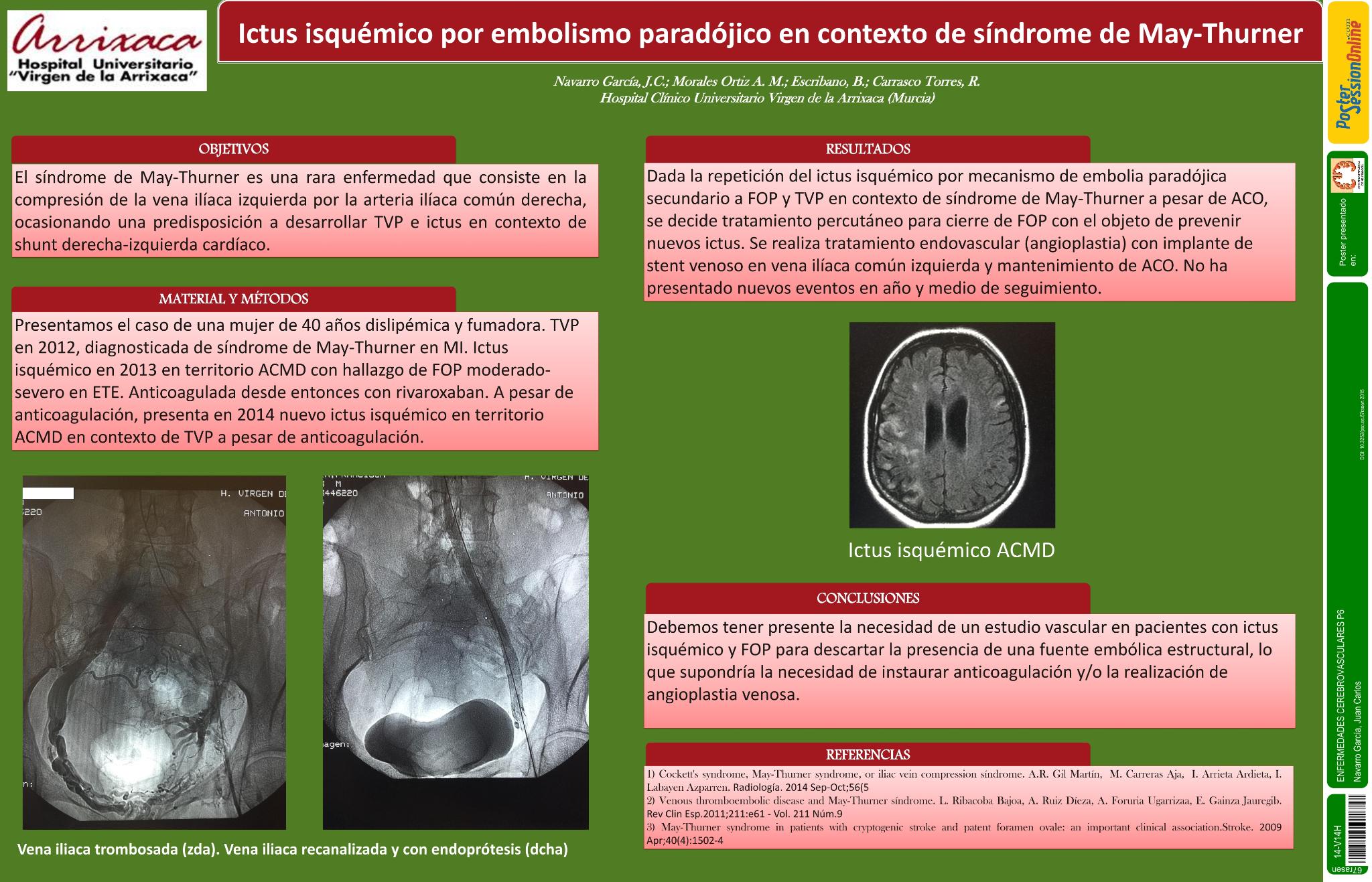 Ictus isquémico por embolismo paradójico en contexto de síndrome de May-Thurner