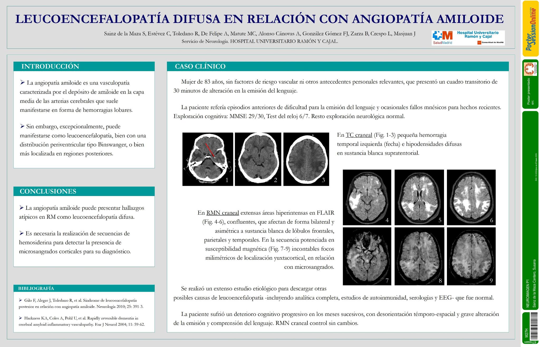 Leucoencefalopatía difusa en relación con angiopatía amiloide