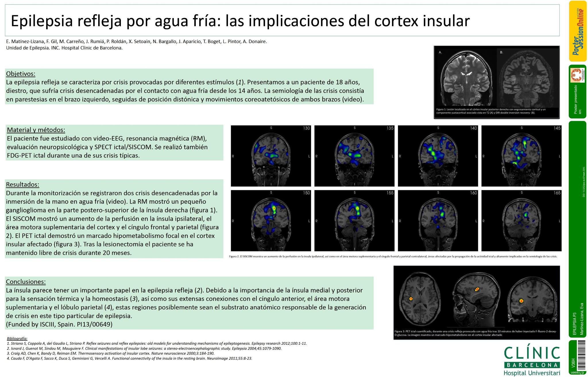 Epilepsia refleja por agua fría: las implicaciones del cortex insular