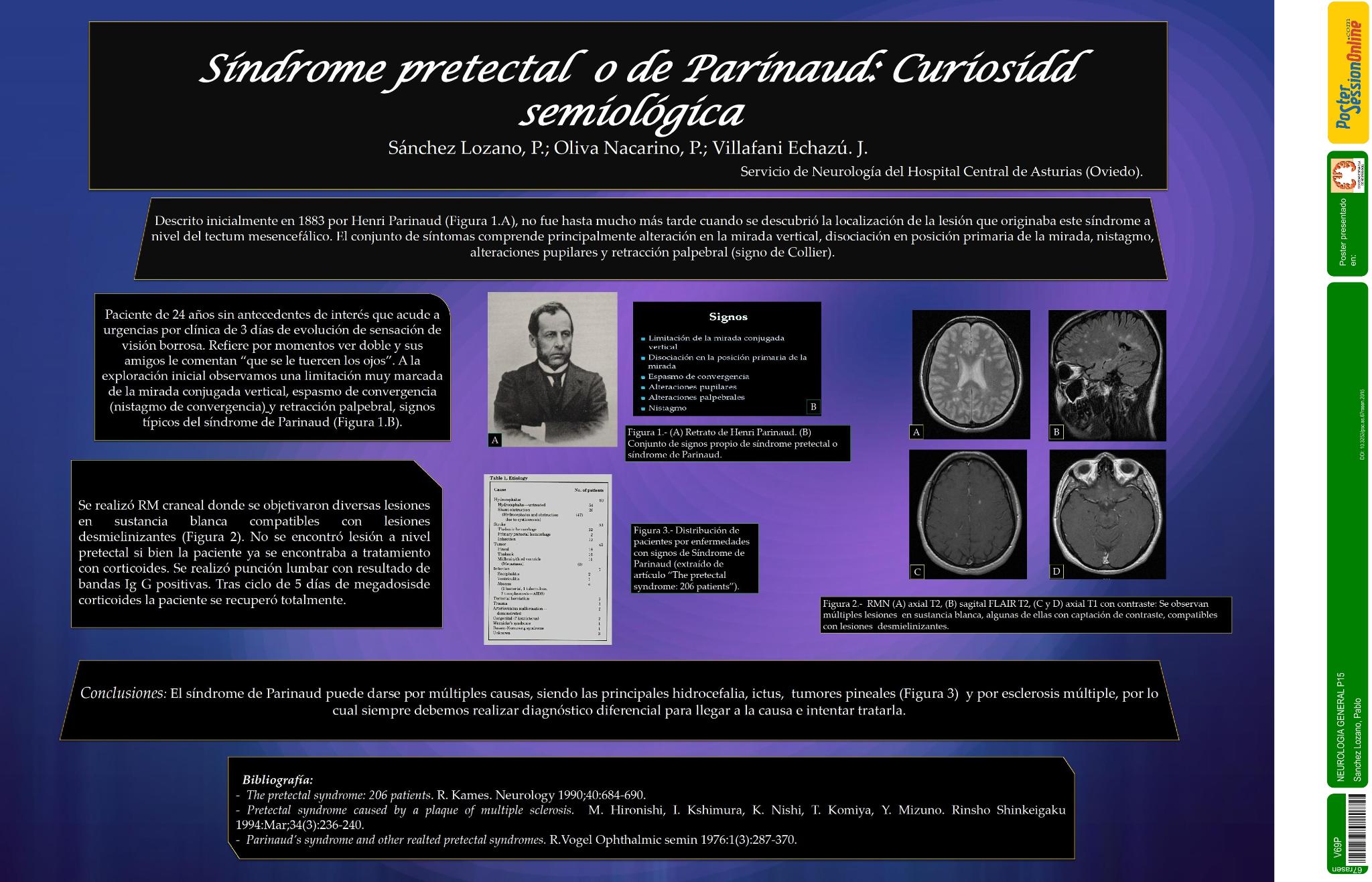 Síndrome pretectal o de Parinaud: curiosidad semiológica