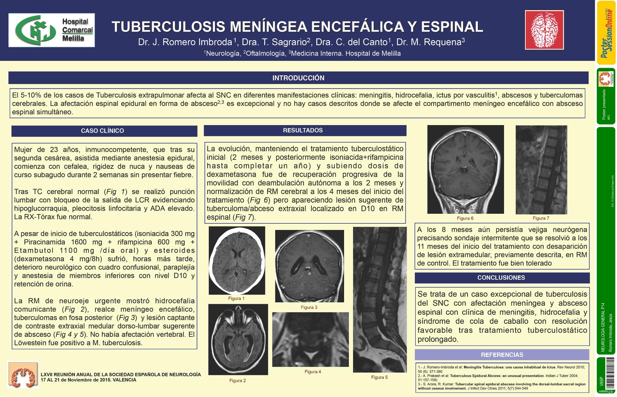 Tuberculosis meníngea encefálica y espinal