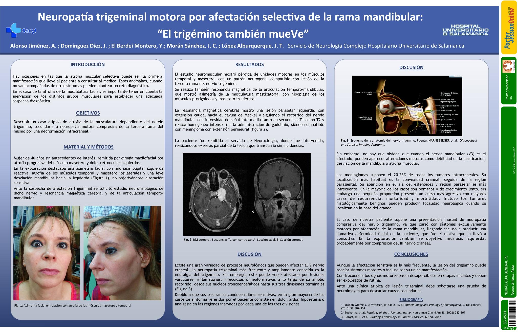 Neuropatia trigeminal motora por afectación selectiva de rama mandibular. "El trigémino también mueve"