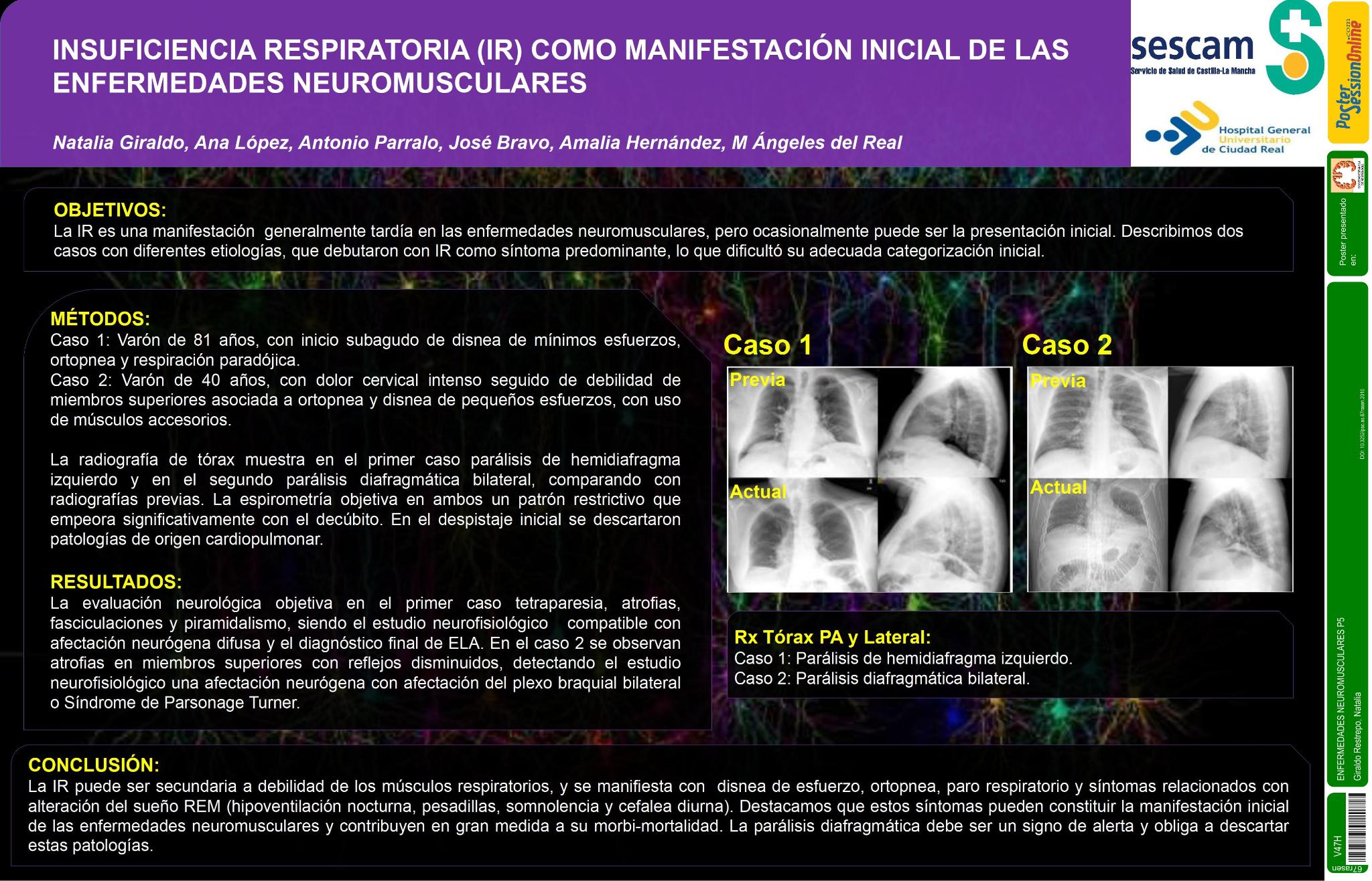 Insuficiencia respiratoria (IR) como manifestación inicial de las enfermedades neuromusculares