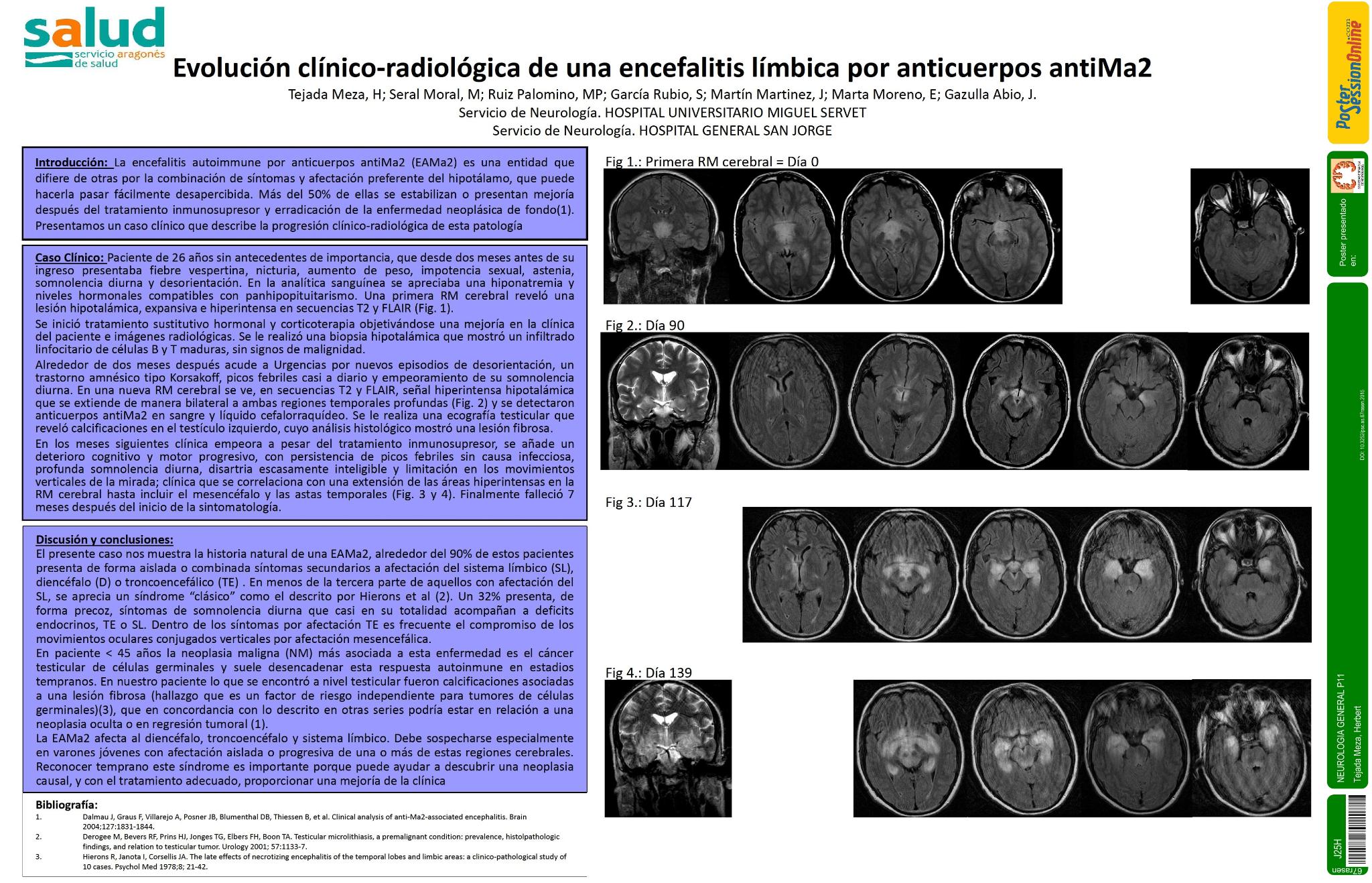 Evolución clínico-radiológica de una encefalitis límbica por anticuerpos anti Ma2