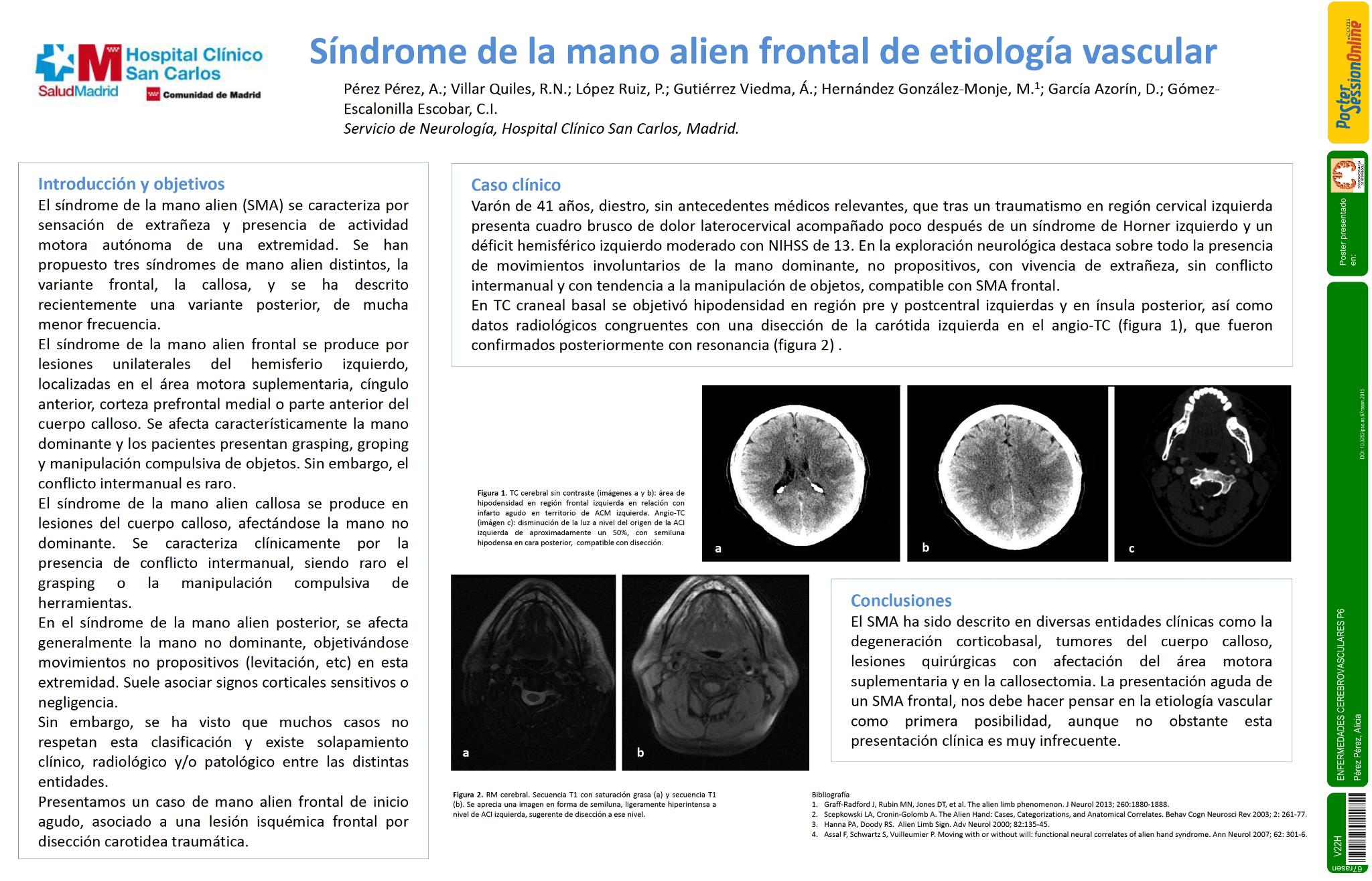 Síndrome de la mano alien frontal de etiología vascular