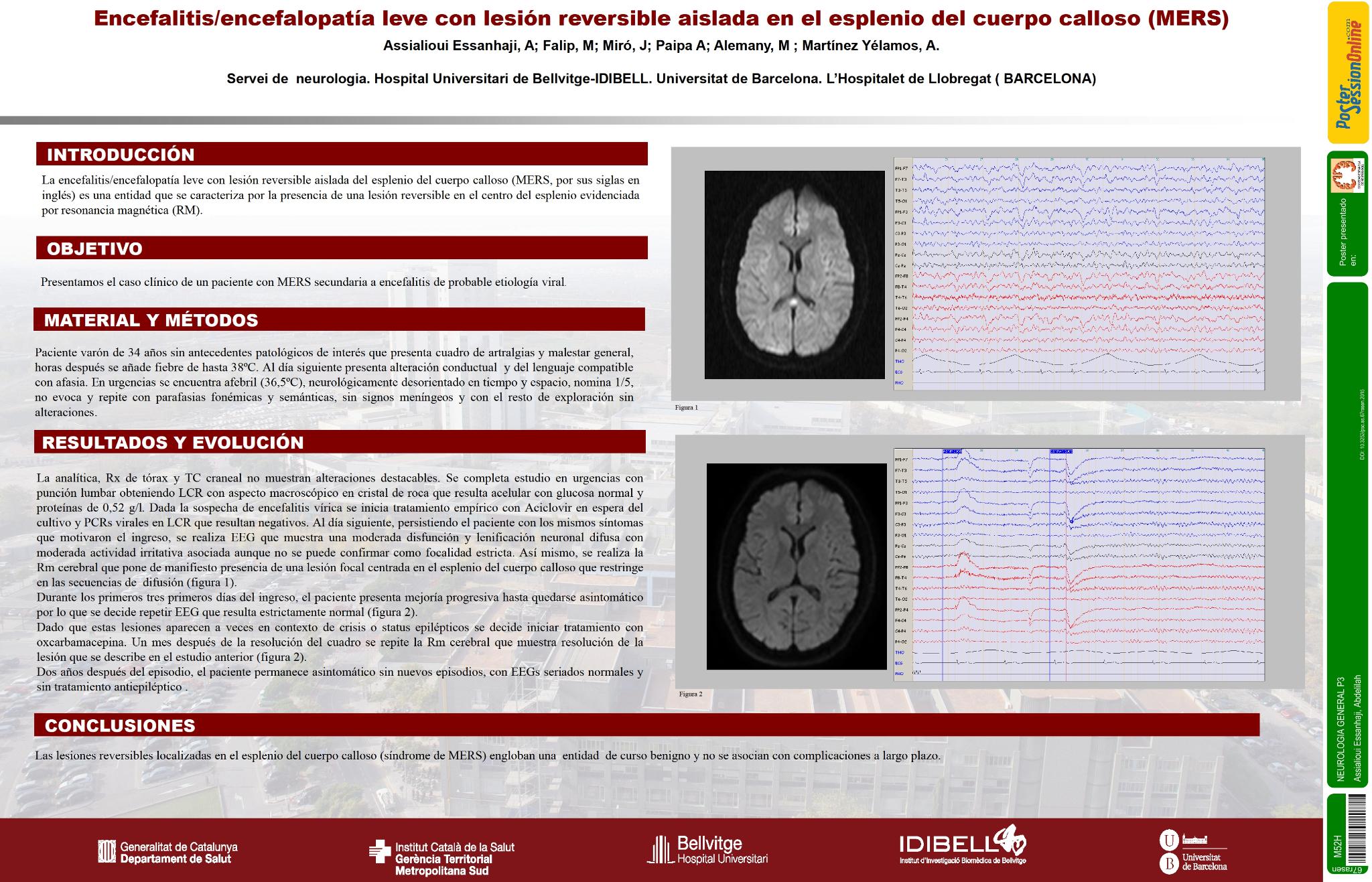 Encefalitis y lesion en el esplenio del cuerpo calloso