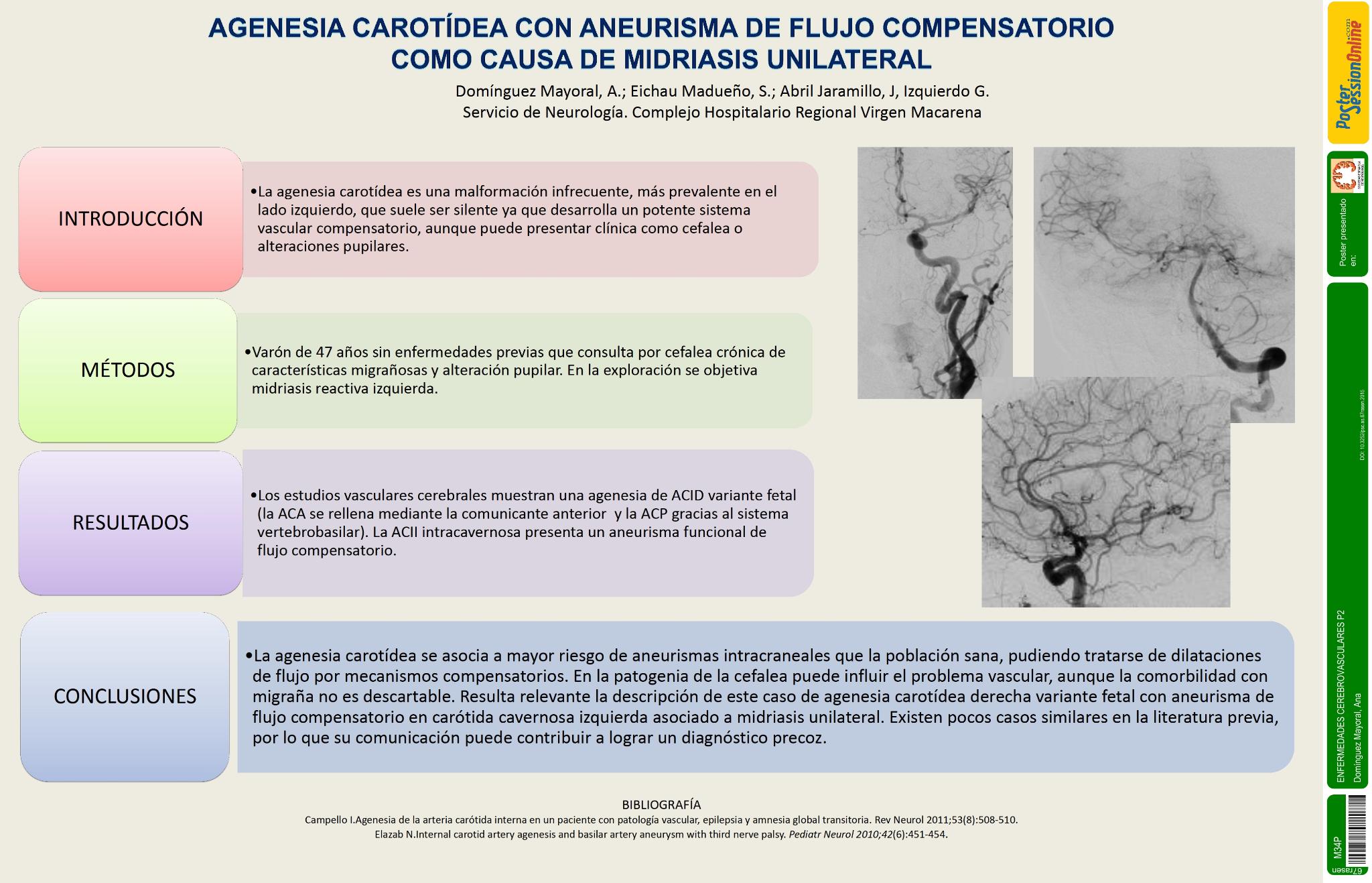 Agenesia carotídea con aneurisma de flujo compensatorio como causa de midriasis unilateral