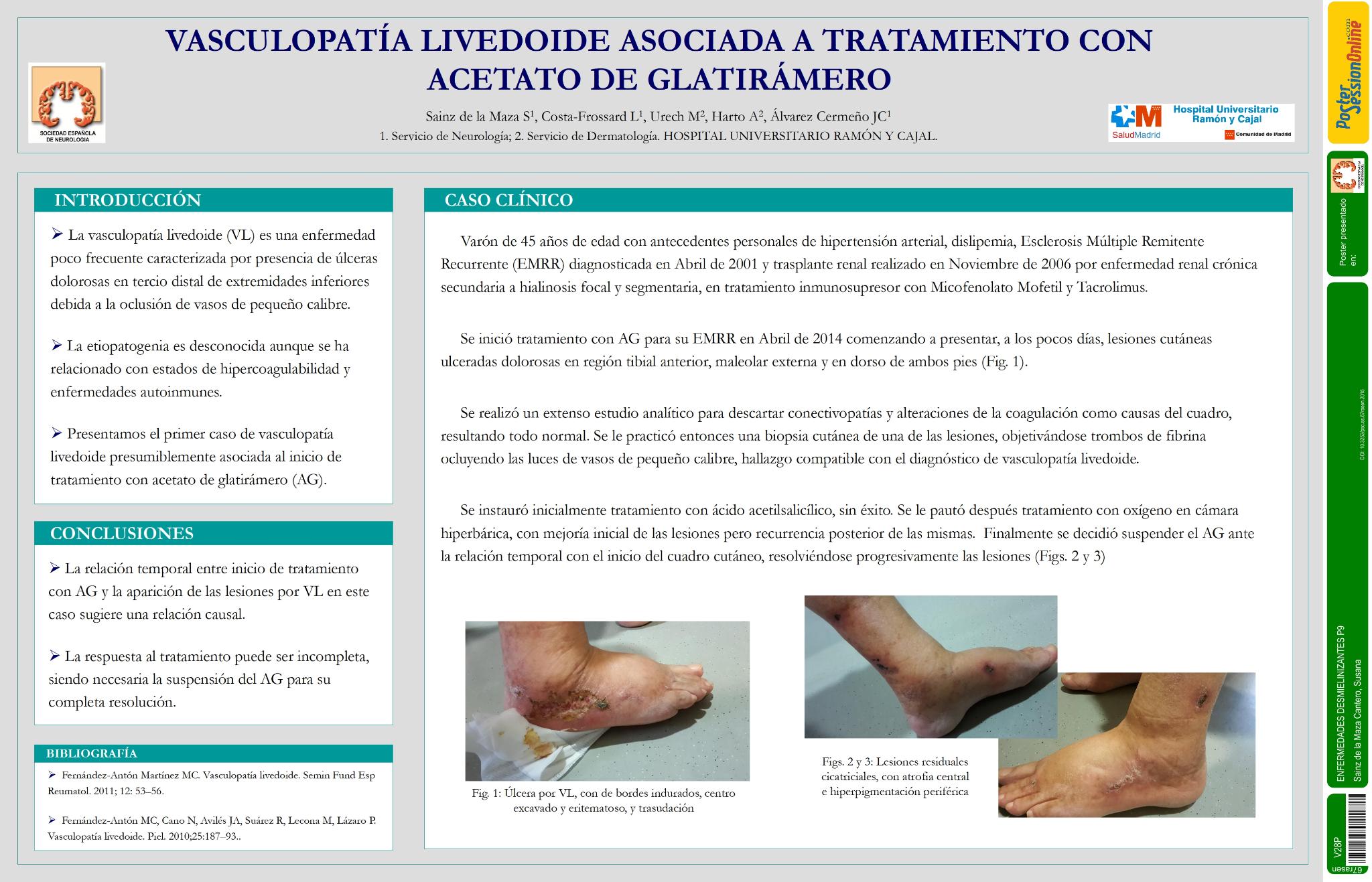Vasculopatía livedoide asociada a tratamiento con acetato de glatirámero