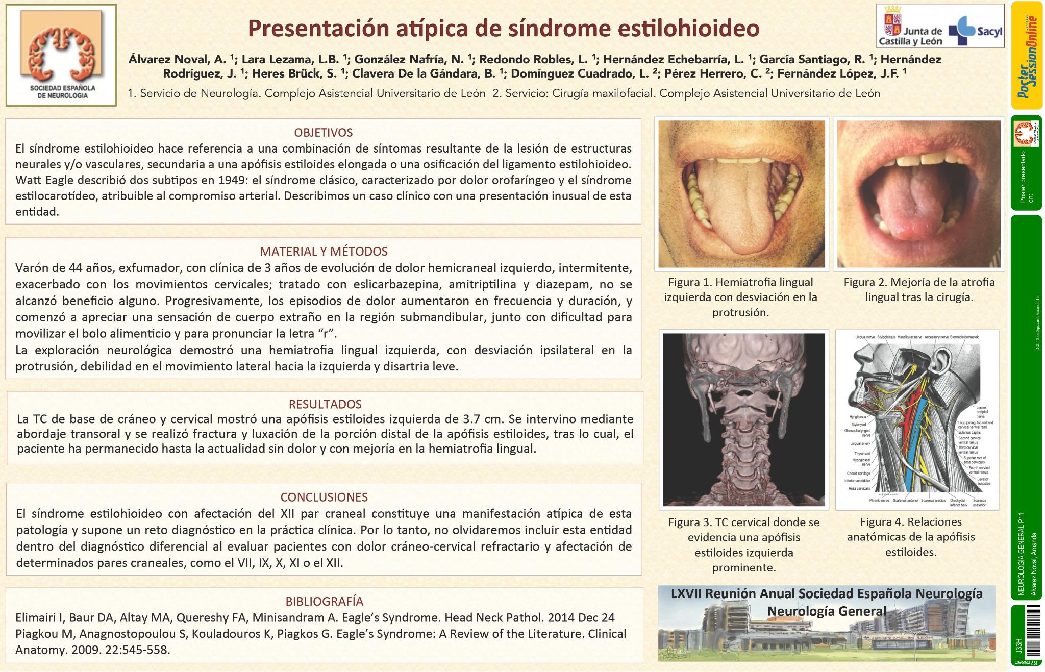 Presentación atípica de síndrome estilohioideo