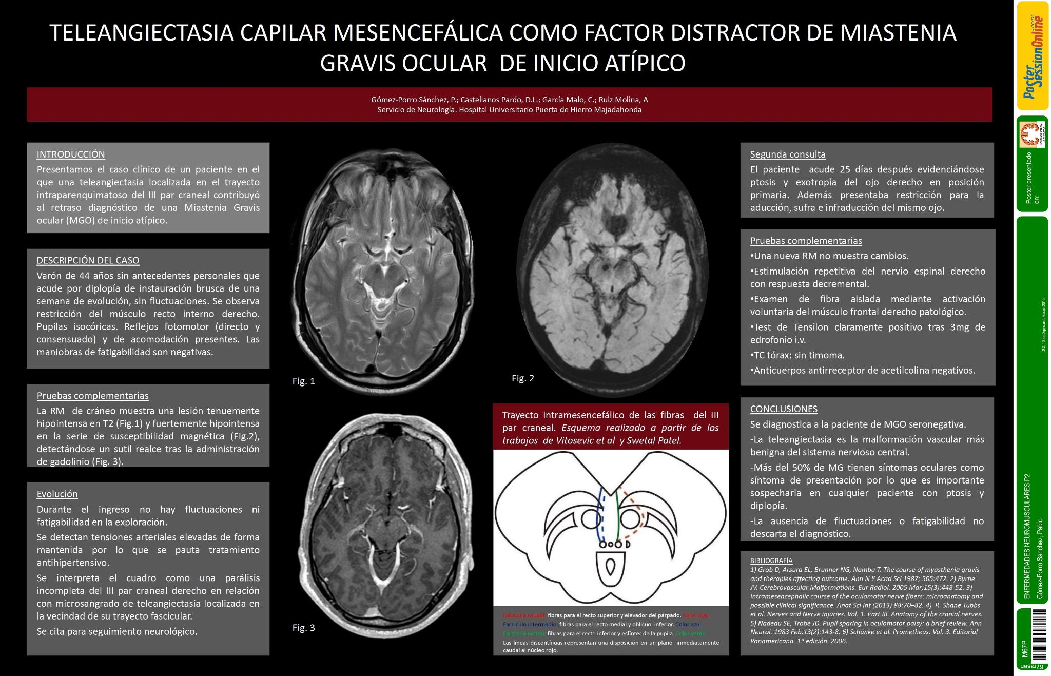 Teleangiectasia capilar mesencefálica como factor distractor de miastenia gravis ocular (MGO) de inicio atípico
